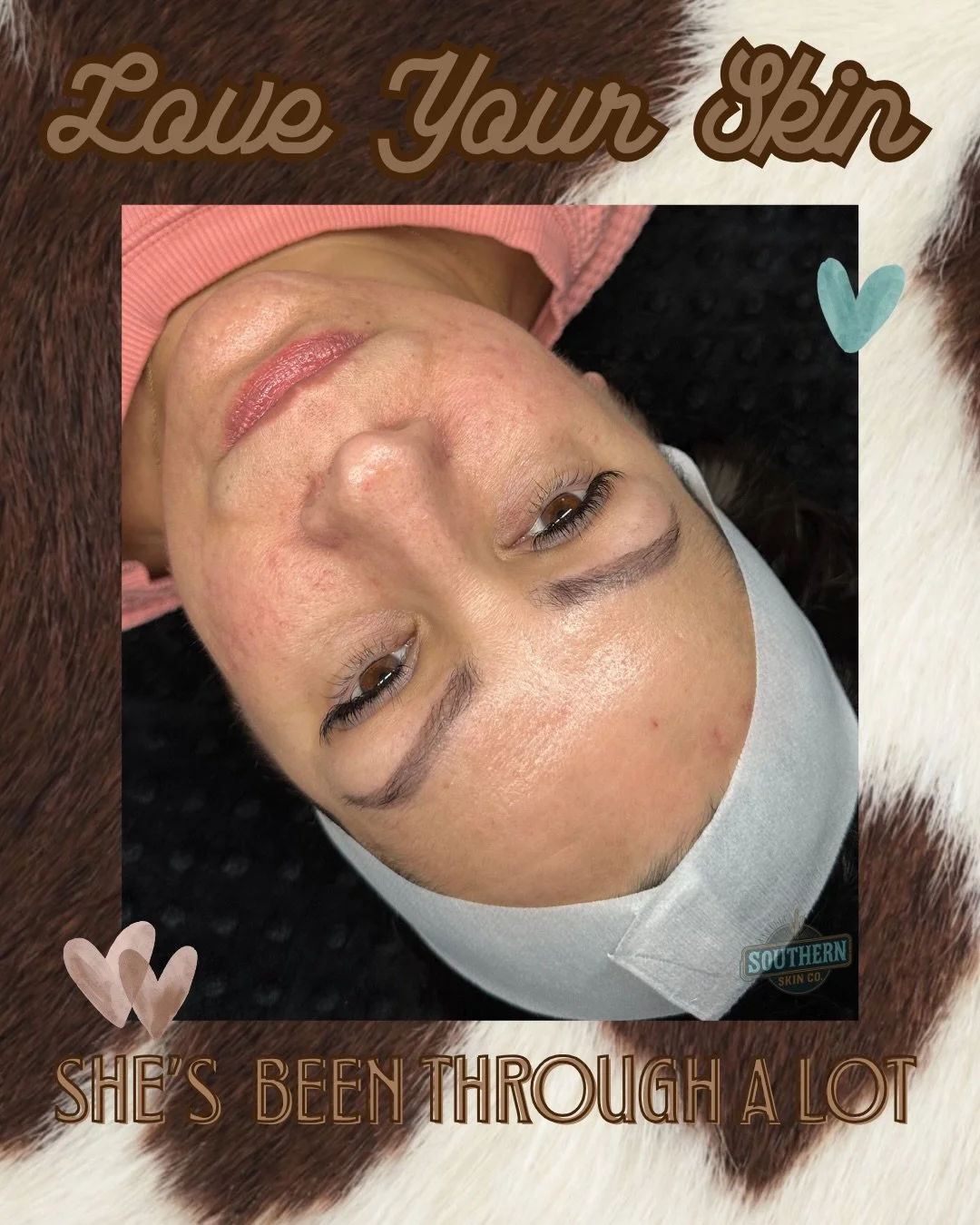 LOVE YOUR SKIN 
🫶🏻 even on breakout days 
🫶🏻 even when it's not perfect
🫶🏻 ESPECIALLY THEN

 Your skin shows up for you every day, show up for your skin. 

🔗 link in my bio to book a consultation &amp; find out how to show up for your skin. 

