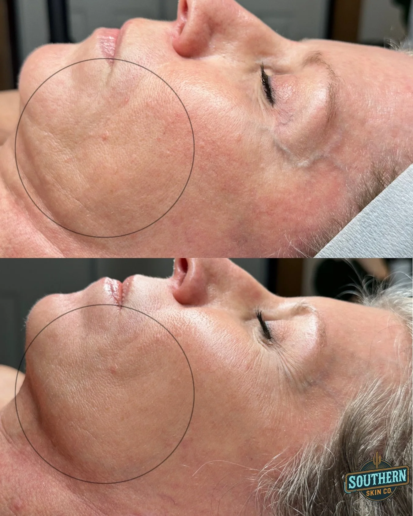 Procell Microchanneling Results🧬⚡️

Think of Procell as hitting the skin reset button. We stimulate collagen, improve elasticity, target damage &amp; bring out your healthiest skin! 

Ready to start your transformation? 

Link to book in my bio or g