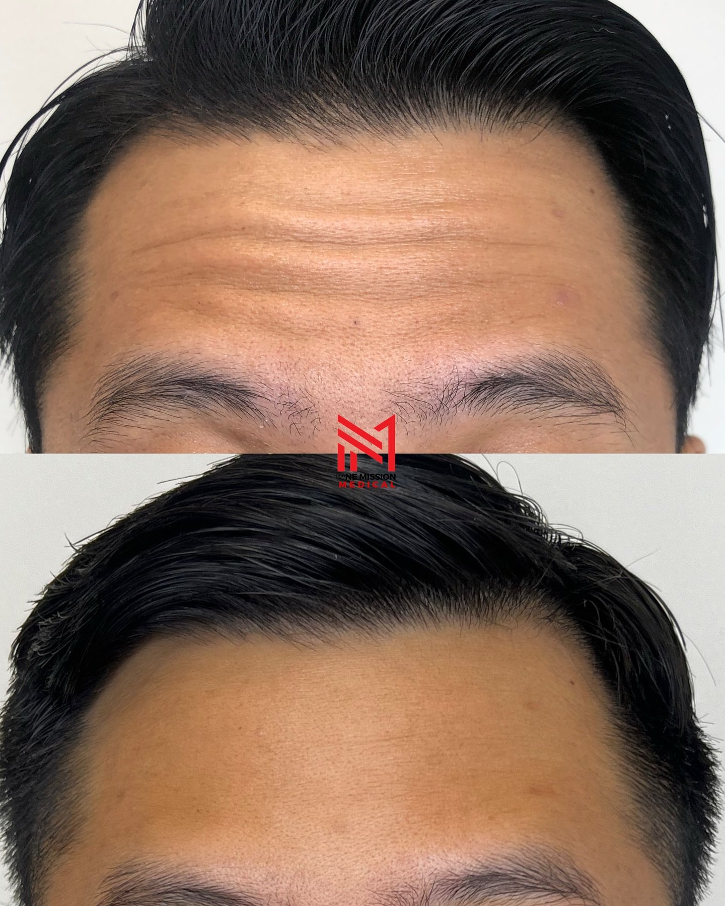 Hey glow-getters! 💉✨ Sharing some Botox before &amp; afters&mdash;finally! Ready for your refresh? 

Call 818-924-7041 or DM us. Catch us at 10200 Sepulveda Blvd. Suite 140, Mission Hills. Let&rsquo;s get you glowing 😜!

#missionhills #botox #befor