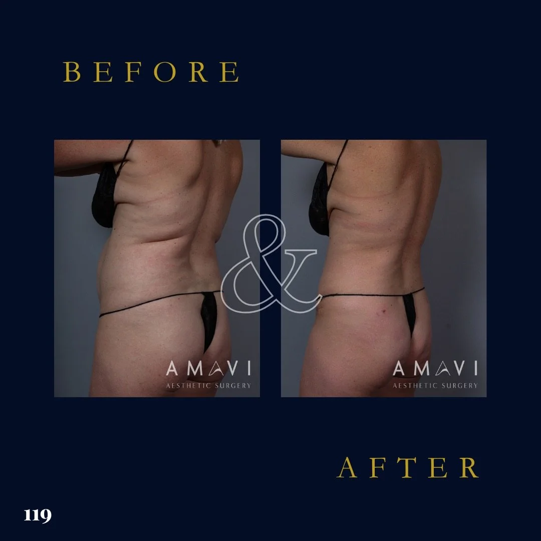 Denver Liposuction Before and After Photos | Dr. Aline Rau
