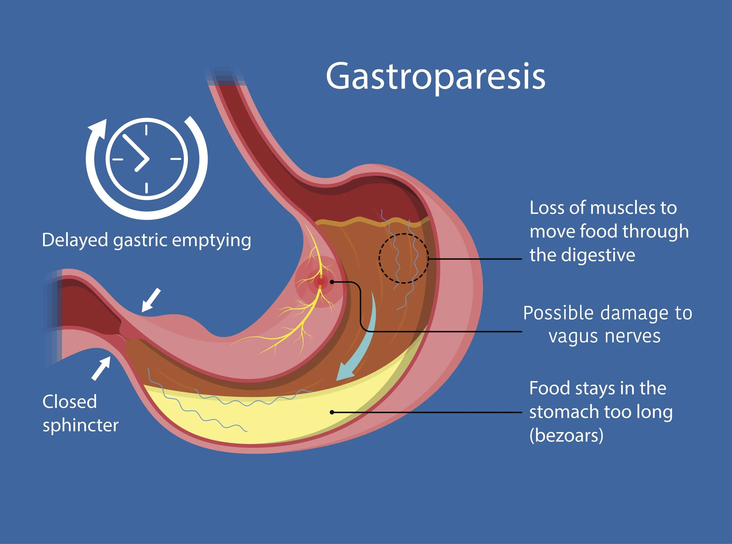Gastroparesis Awareness Month: Understanding a Silent Digestive Disorder
