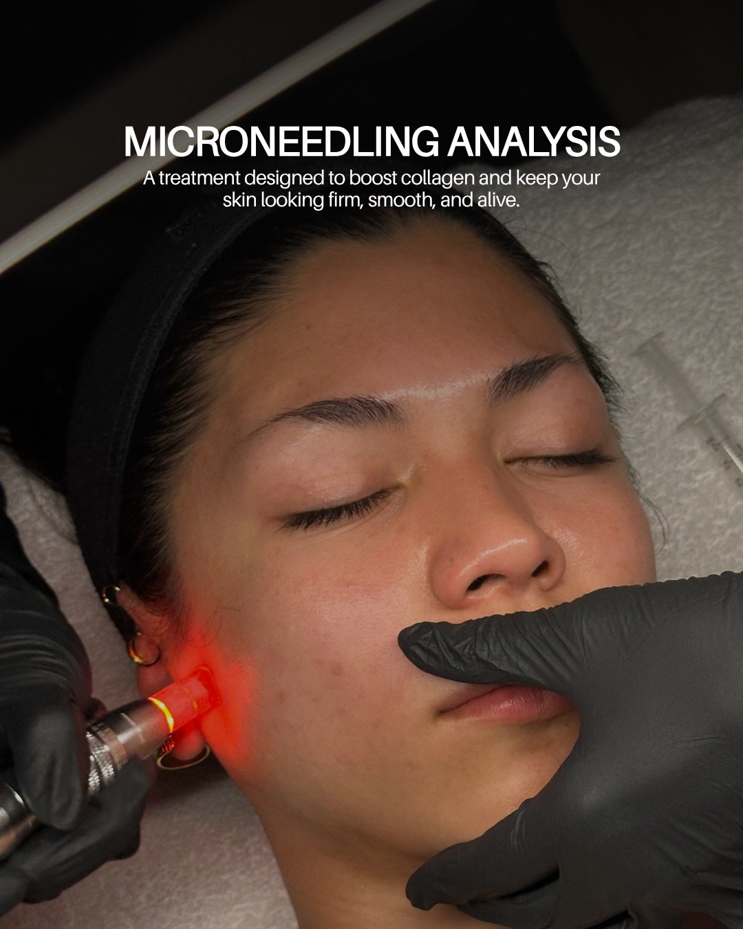 This is how we rebuild your skin. 👀✨

Microneedling 💉 boosts collagen production, smooths texture, and helps your skin start acting the way it used to. It&rsquo;s one of our go-to treatments for clients who want real, long-term results.

Microneedl