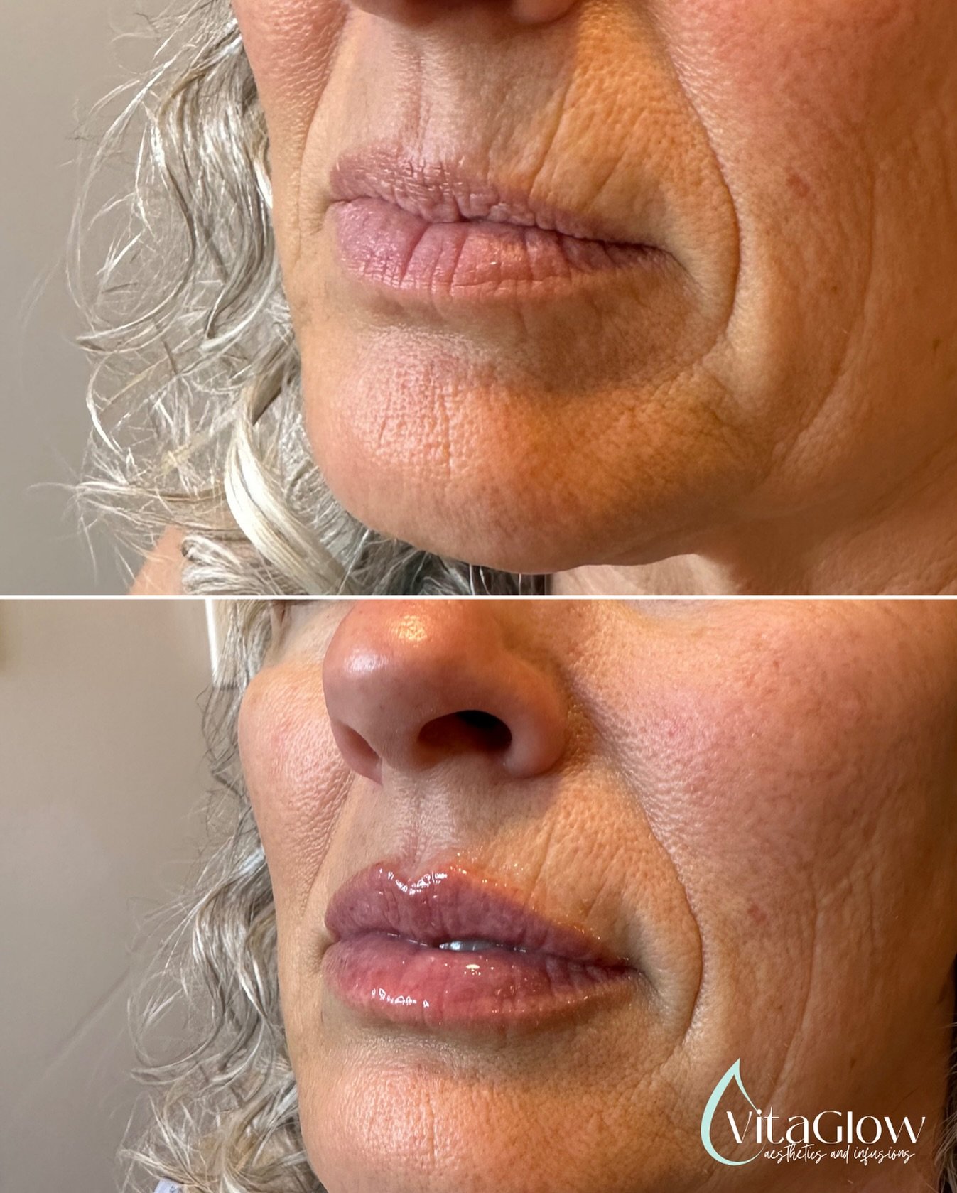 Before and after for my beautiful client. For these results we did 1/2 syringe of Evolysse Smooth. 😍 #lipfiller #evolysse #lipfillerbeforeandafter #mobileivtherapy 

📞208-219-3543
📱DM, text or use booking link in bio. 
💻www.vitaglowidaho.com
📩co