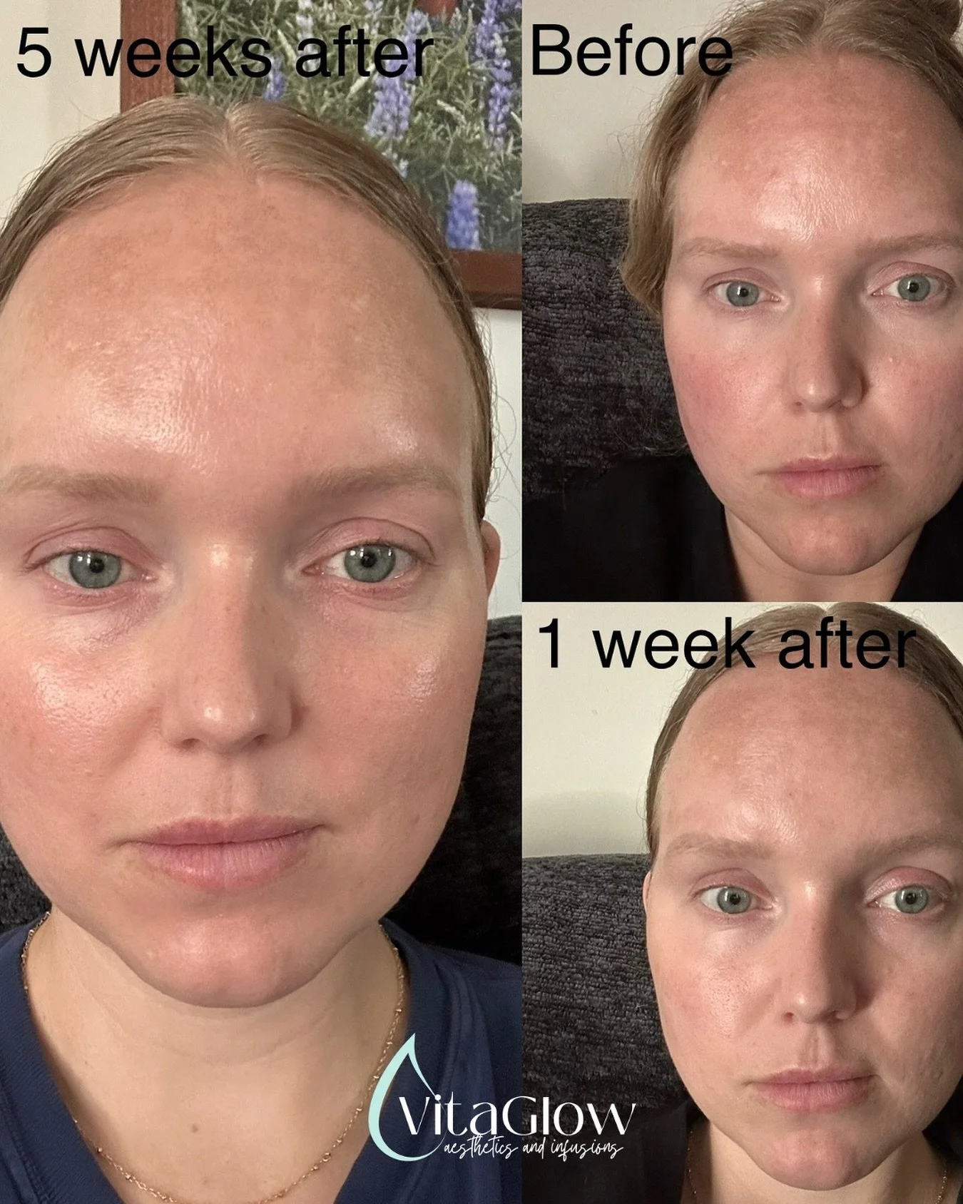 SkinPen Glow in Action✨😍

This is from only 1 treatment!
From texture to tone, SkinPen microneedling is all about real, natural results 💖
✔️ Stimulates collagen &amp; elastin
✔️ Smooths fine lines
✔️ Brightens skin tone

Your skin, but refreshed + 