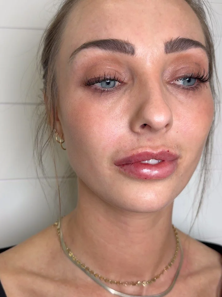 Happy Monday 💋 #lipfillers #medspa #aestheticnurseinjector #justbuythelips #vitaglow We offer Cherry financing- fast and simple payment plans🍒💳

📞208-219-3543
📱DM, text or use booking link in bio. 
💻www.vitaglowidaho.com
📩contactvitaglow@gmail