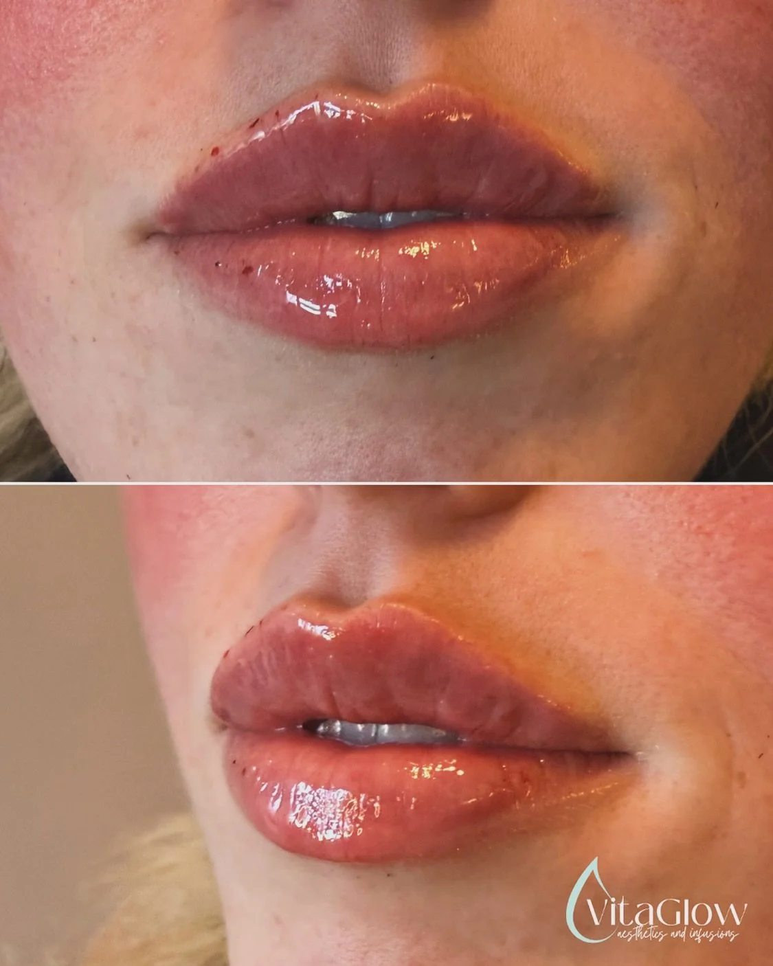 Pretty lips for a very special client of mine 💋 #lipfillers #lipfillertwinfalls #mobileivtherapy #botox #jeuveau #rhafiller #juverderm 

We offer Cherry financing- fast and simple payment plans🍒💳

📞208-219-3543
📱DM, text or use booking link in b