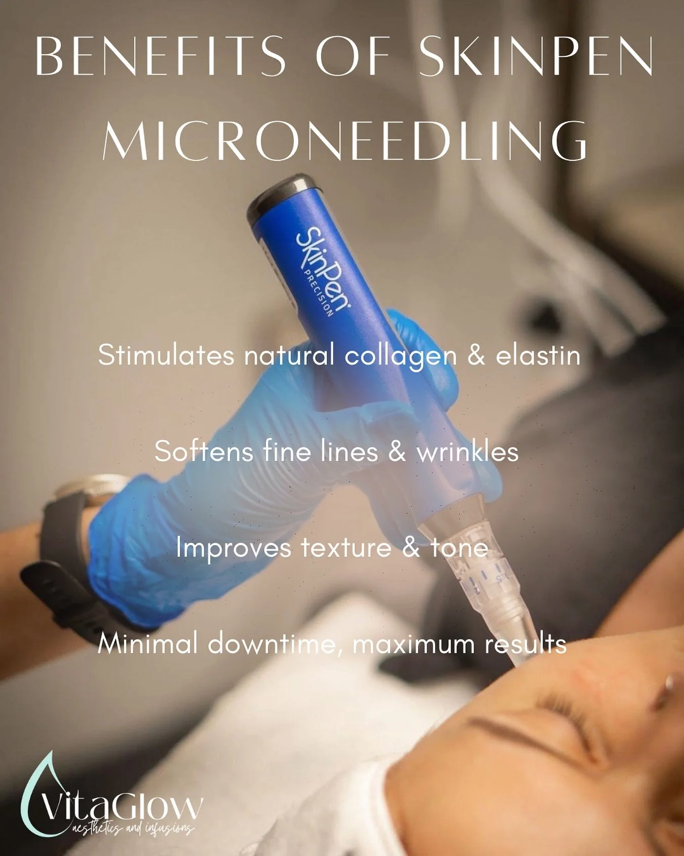 ✨ SkinPen Microneedling = Collagen Confidence ✨

This treatment works beneath the surface to:
▫️ Smooth fine lines &amp; wrinkles
▫️ Fade acne scars &amp; stretch marks
▫️ Improve skin tone &amp; texture
▫️ Boost collagen for that youthful glow 

#Sk