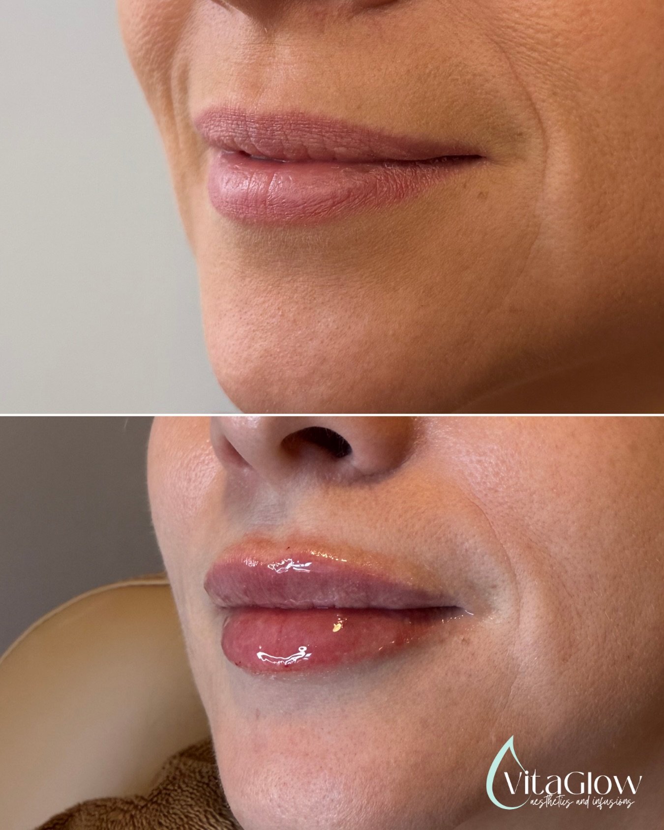Plump &amp; Pretty💋 #lipfillers #lipfillertwinfalls #lipfillerburleyidaho #mobileivtherapy #botox #jeuveau #rhafiller #juverderm #lipfiller #aesthetics #lipfillerbeforeandafter 

We offer Cherry financing- fast and simple payment plans with no hard 