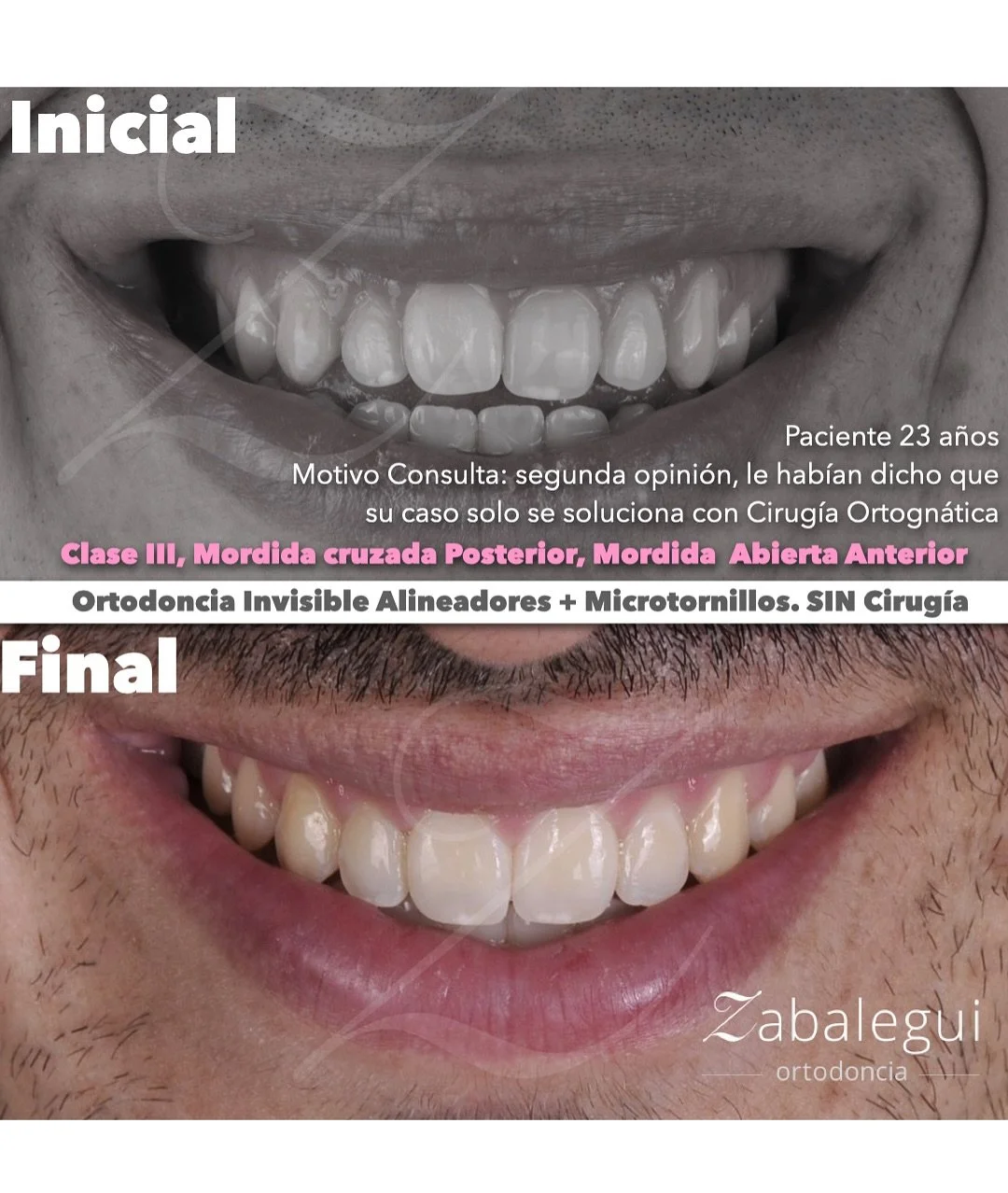 Qu&eacute; os parece este caso, tratado con Ortodoncia Invisible y Microtornillos, sin cirug&iacute;a ni extracciones. 

Este chico ven&iacute;a por una segunda opini&oacute;n, con clase III, mordida cruzada posterior y mordida abierta anterior, que 