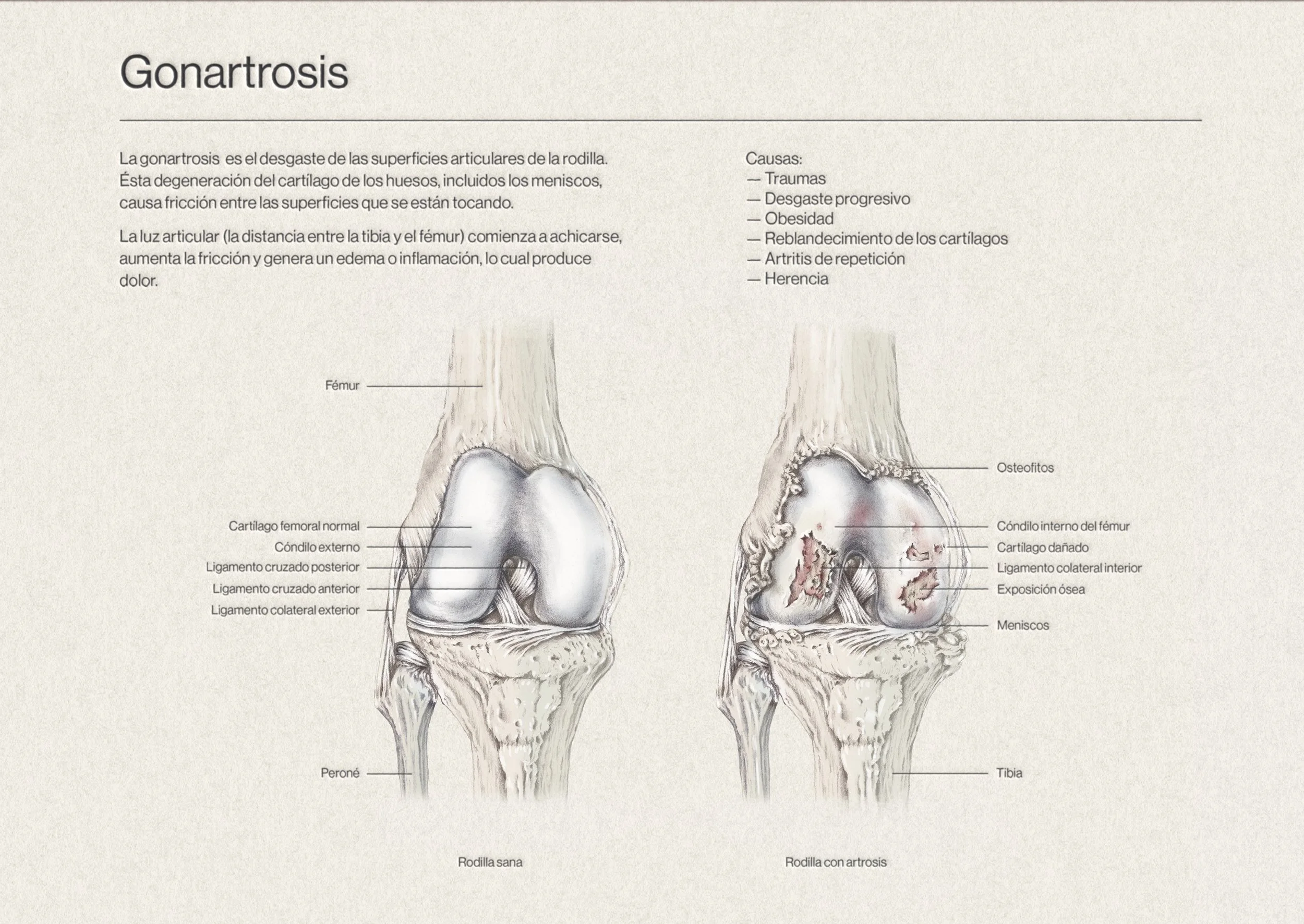 ilustracion_medica_brenda_temores_gonartrosis.jpg