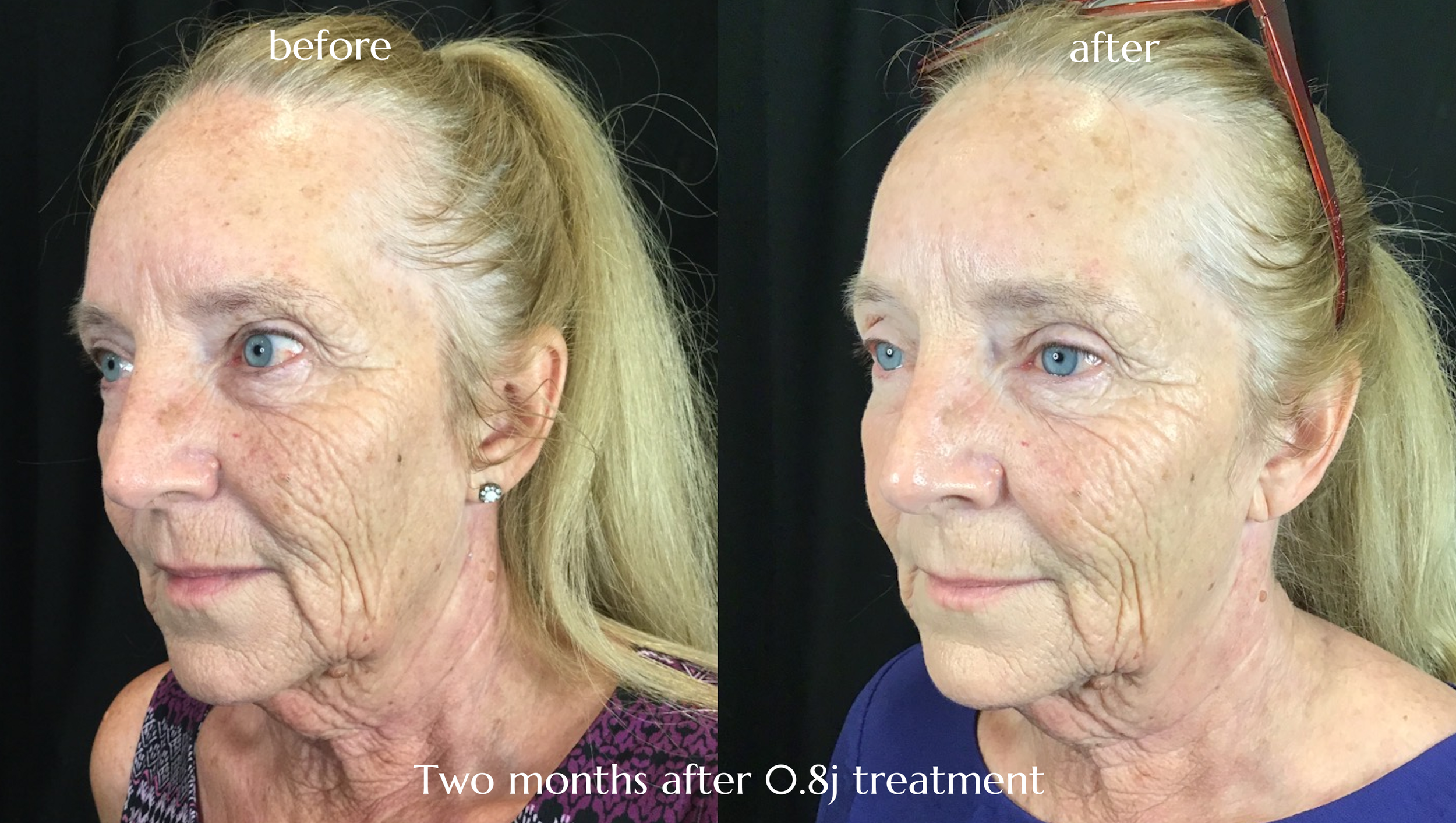 Before and after photos showing improvement to deep cheek wrinkles, the 'after' taken two months after 0.8j treatment