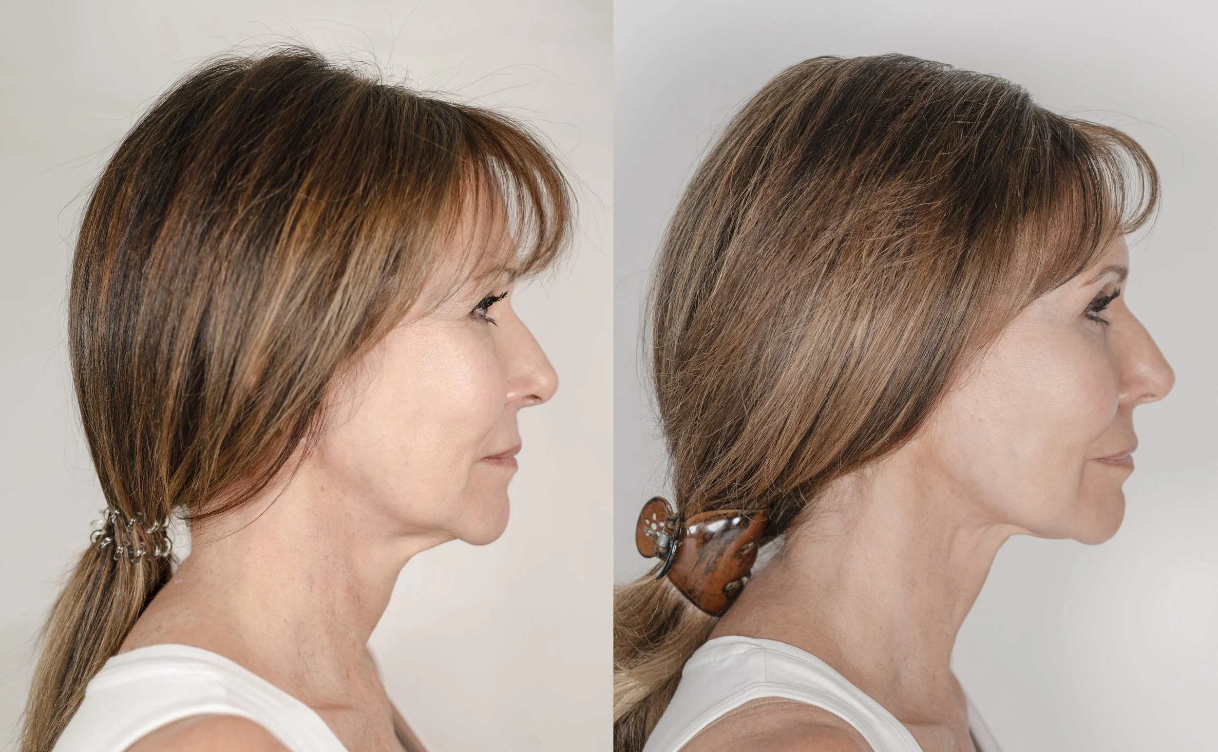 Before and after Neogen Plasma photos of Linda Lusardi