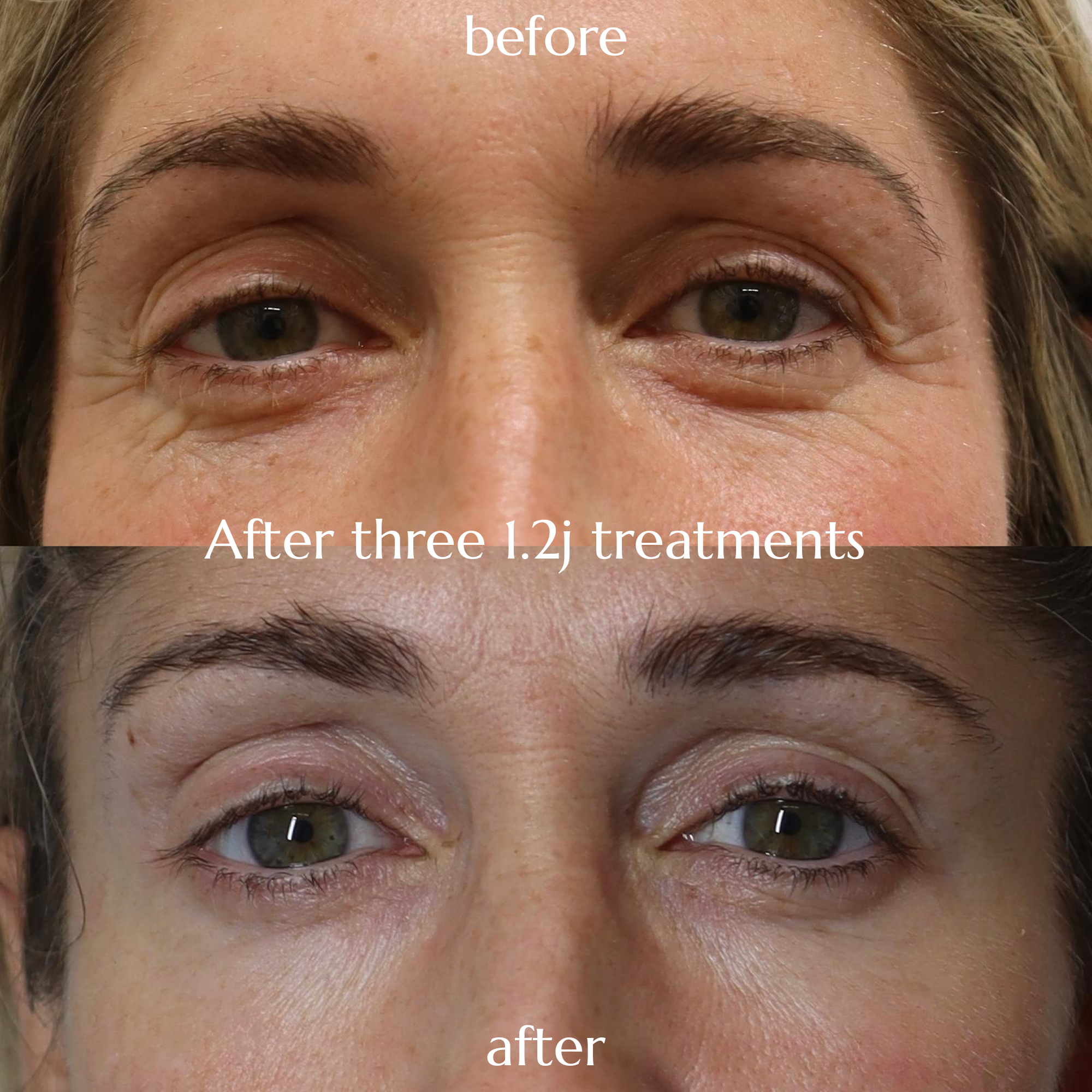 Before and after photos showing improvement to crow's feet, with the 'after' photo taken after three 1.2j treatments
