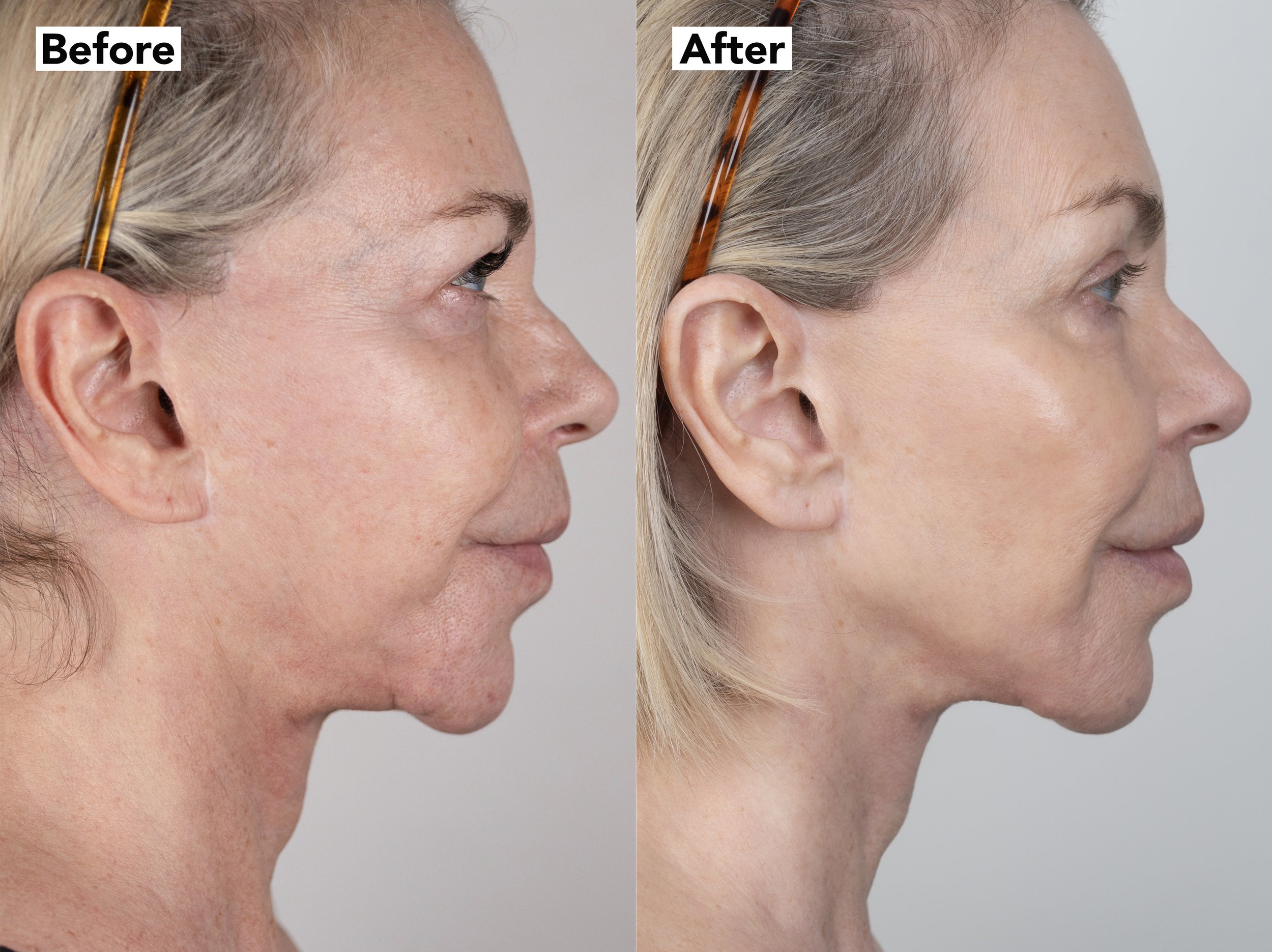 Before and after Neogen Plasma photos of Leslie Ash