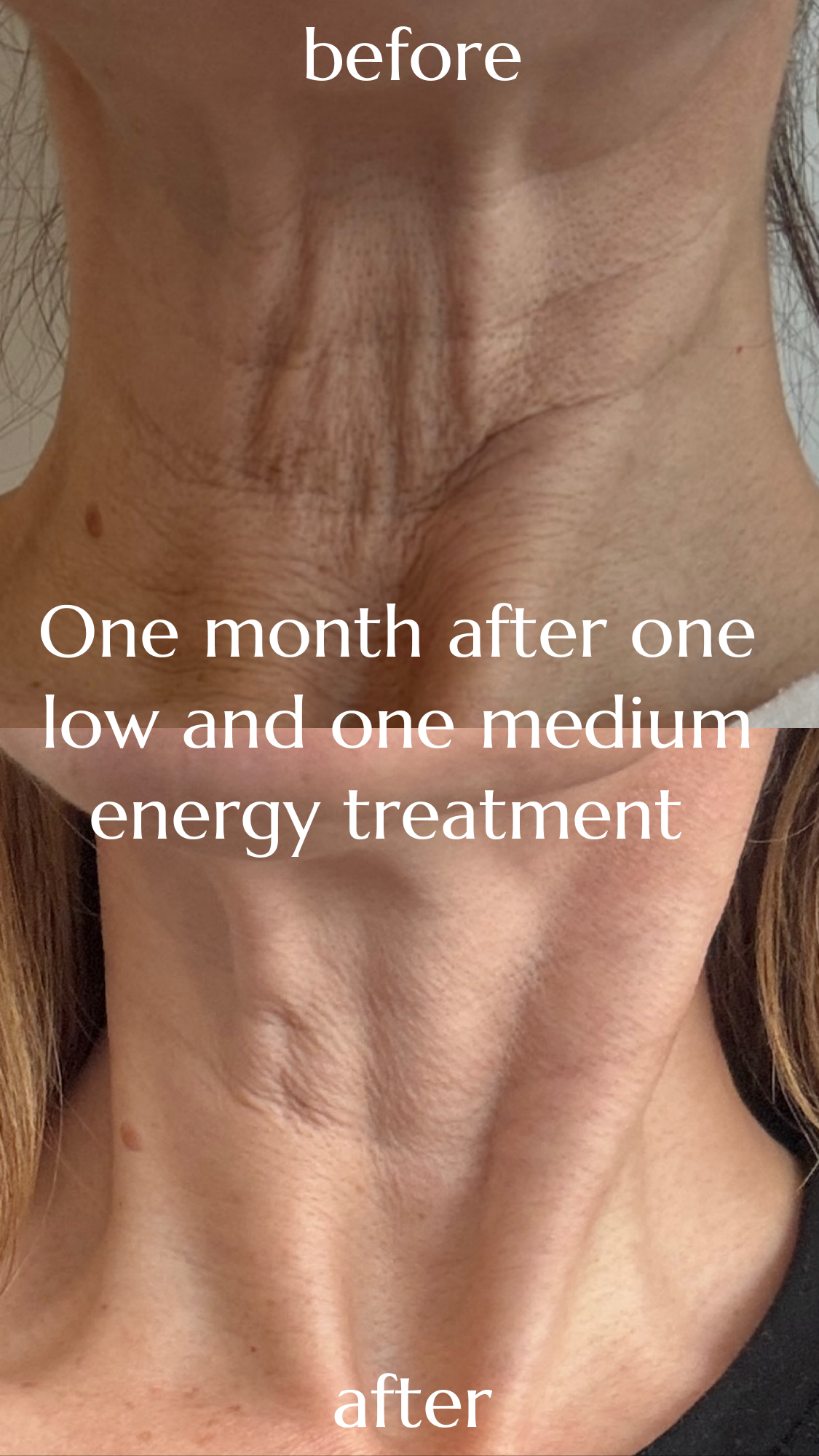 Before and after photos showing improvement to neck area, with the 'after' photo taken one month after one low and one medium energy treatment