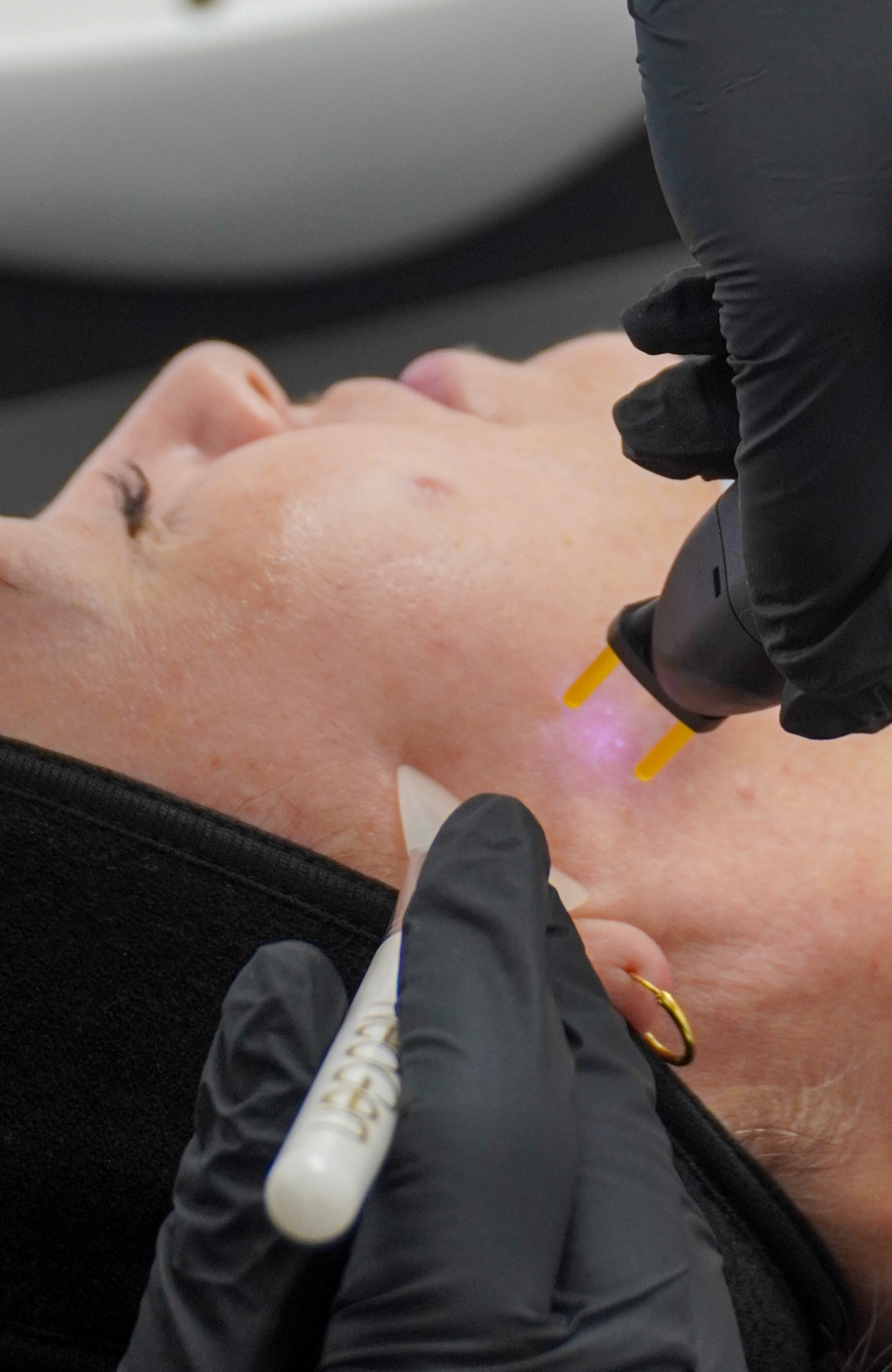 Close up of Neogen being applied to a client's cheek with a blue plasma pulse visible