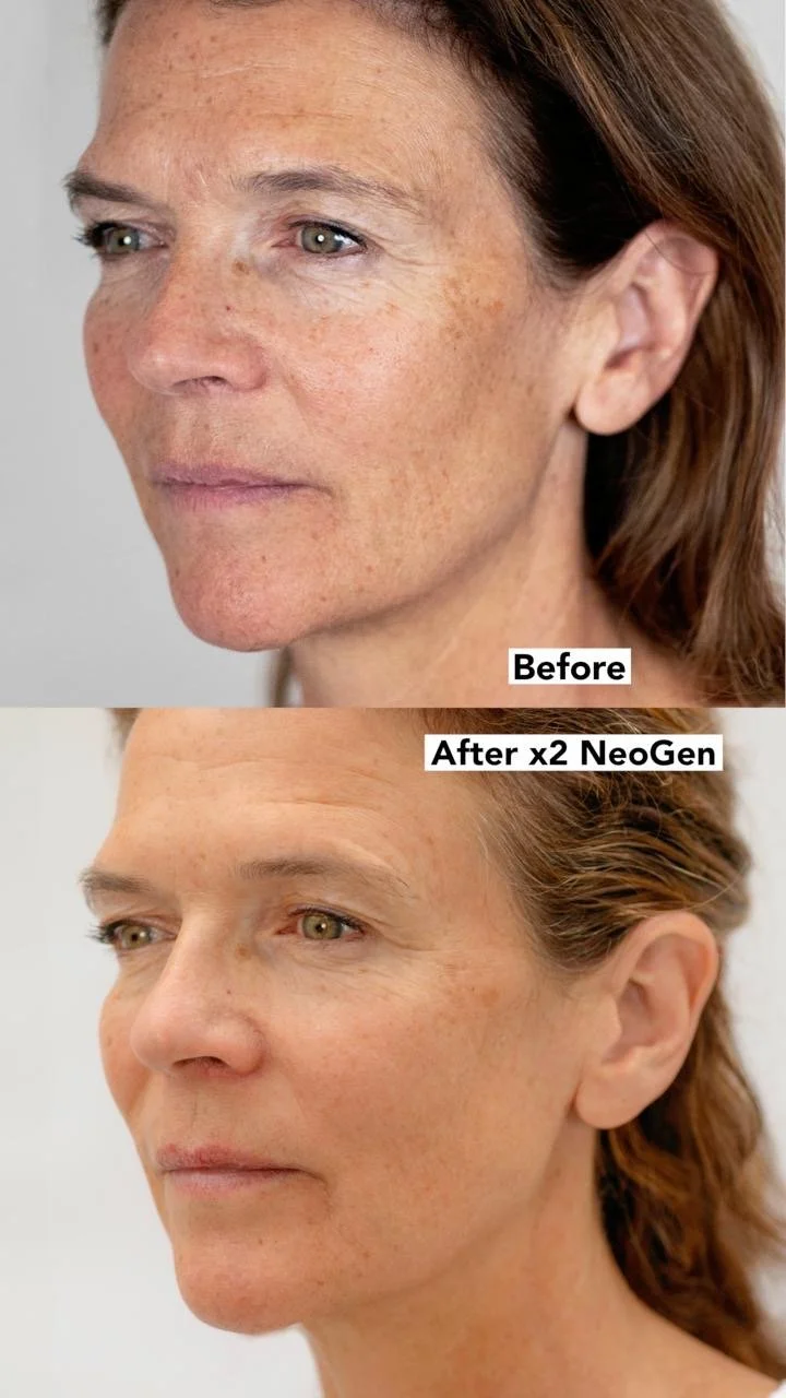 Before and after Neogen Plasma photos of Annabel Croft