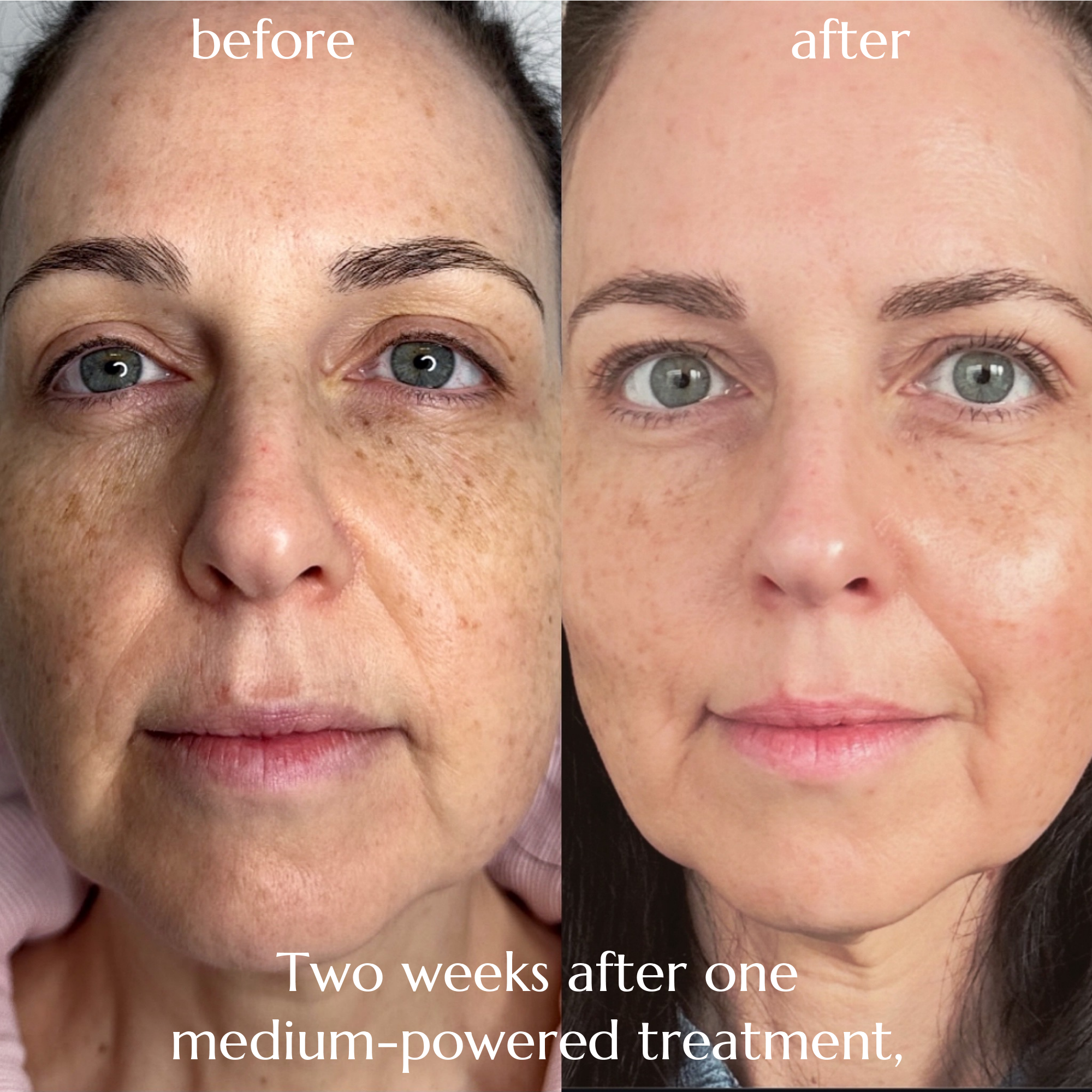 Before and after photo showing improvement to face wrinkles and laxity, with the 'after' taken two weeks after one medium-powered treatment