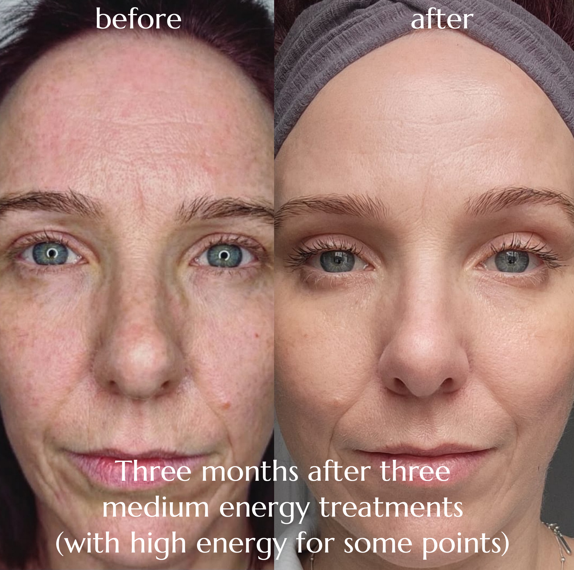 Before and after photos showing improvement to facial skin, with the 'after' taken three months after three medium energy treatments (with high energy for some points)