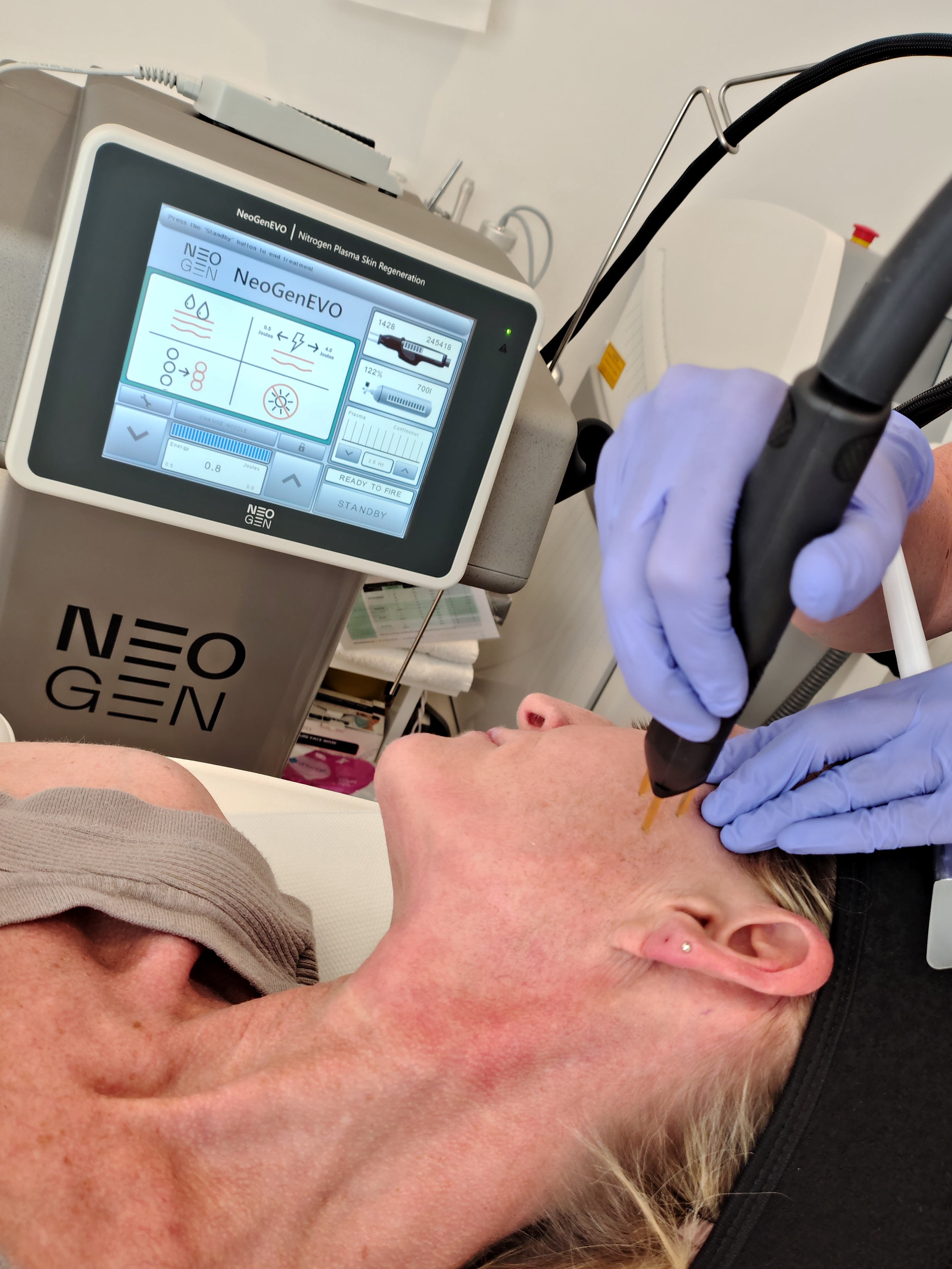 Close up of a client receiving NeoGen treatment on their cheek, with the NeoGen machine in the background