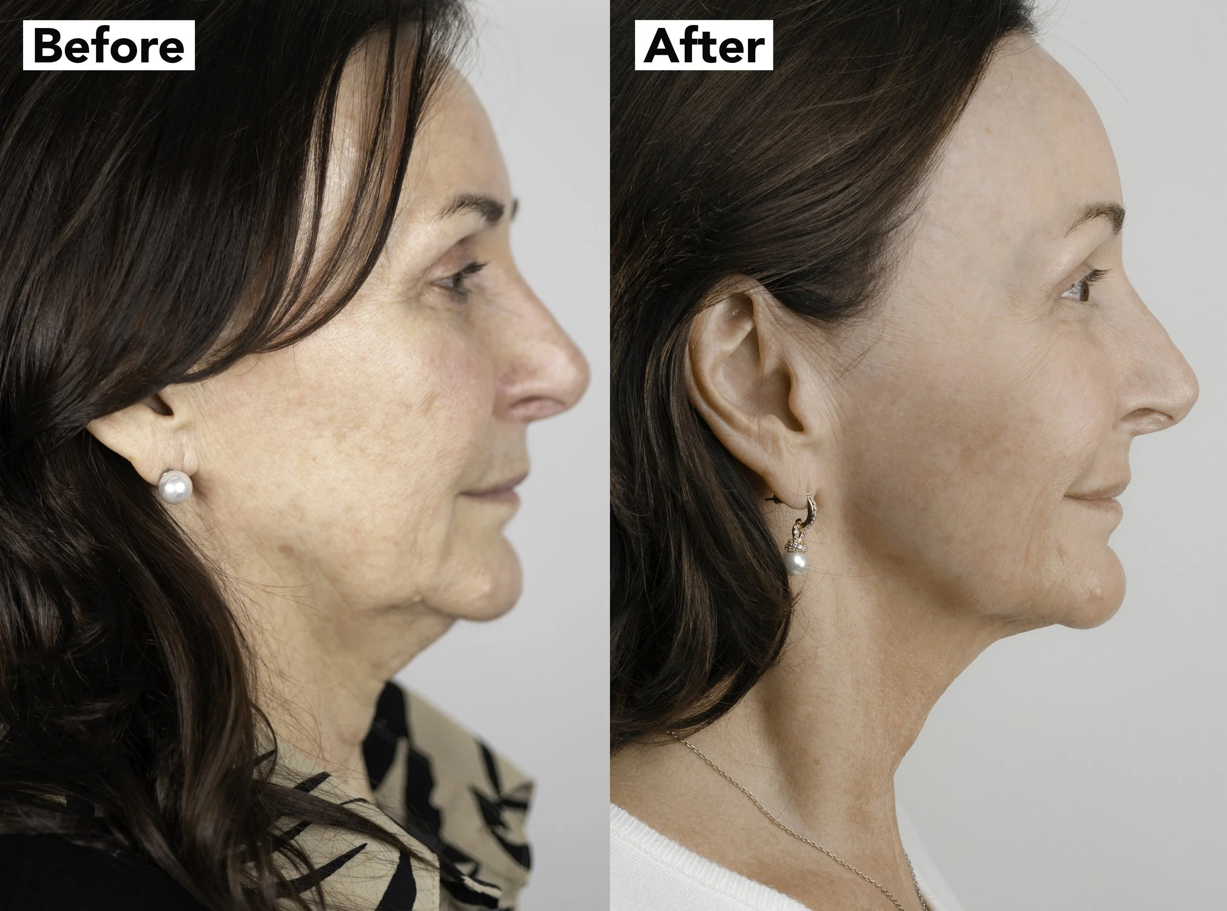 Before and after photos showing the changes to Shirley Ballas's face from Neogen Plasma