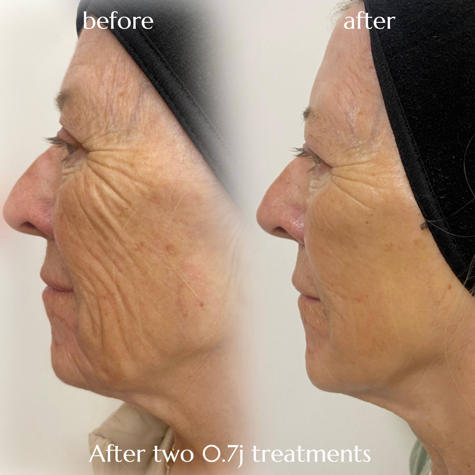 Before and after photo showing improvement to ageing wrinkles, with the 'after' taken after 0.7j treatments