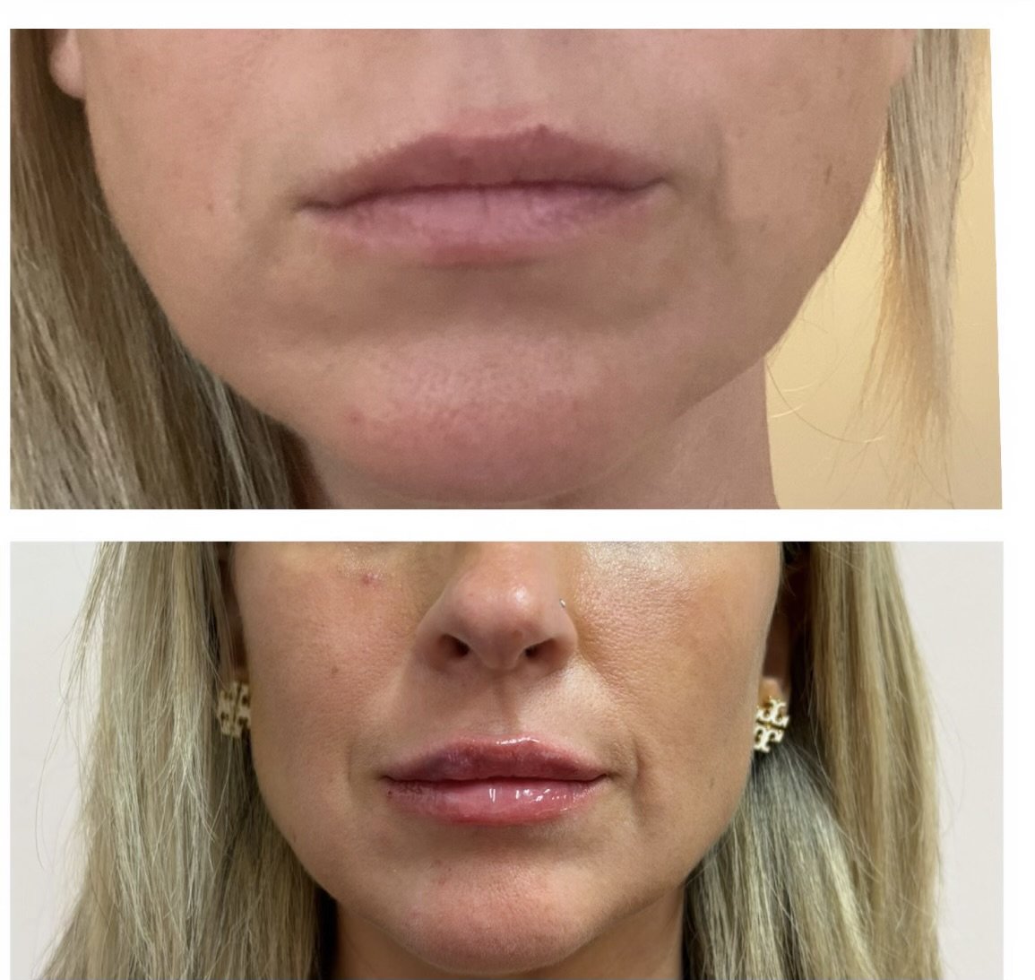 Lip Filler