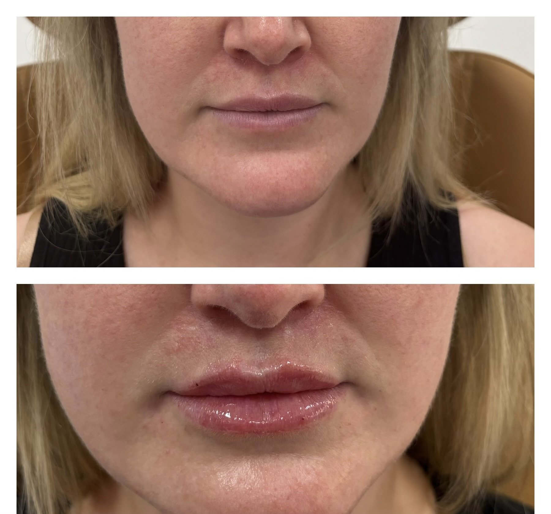 Lip Filler