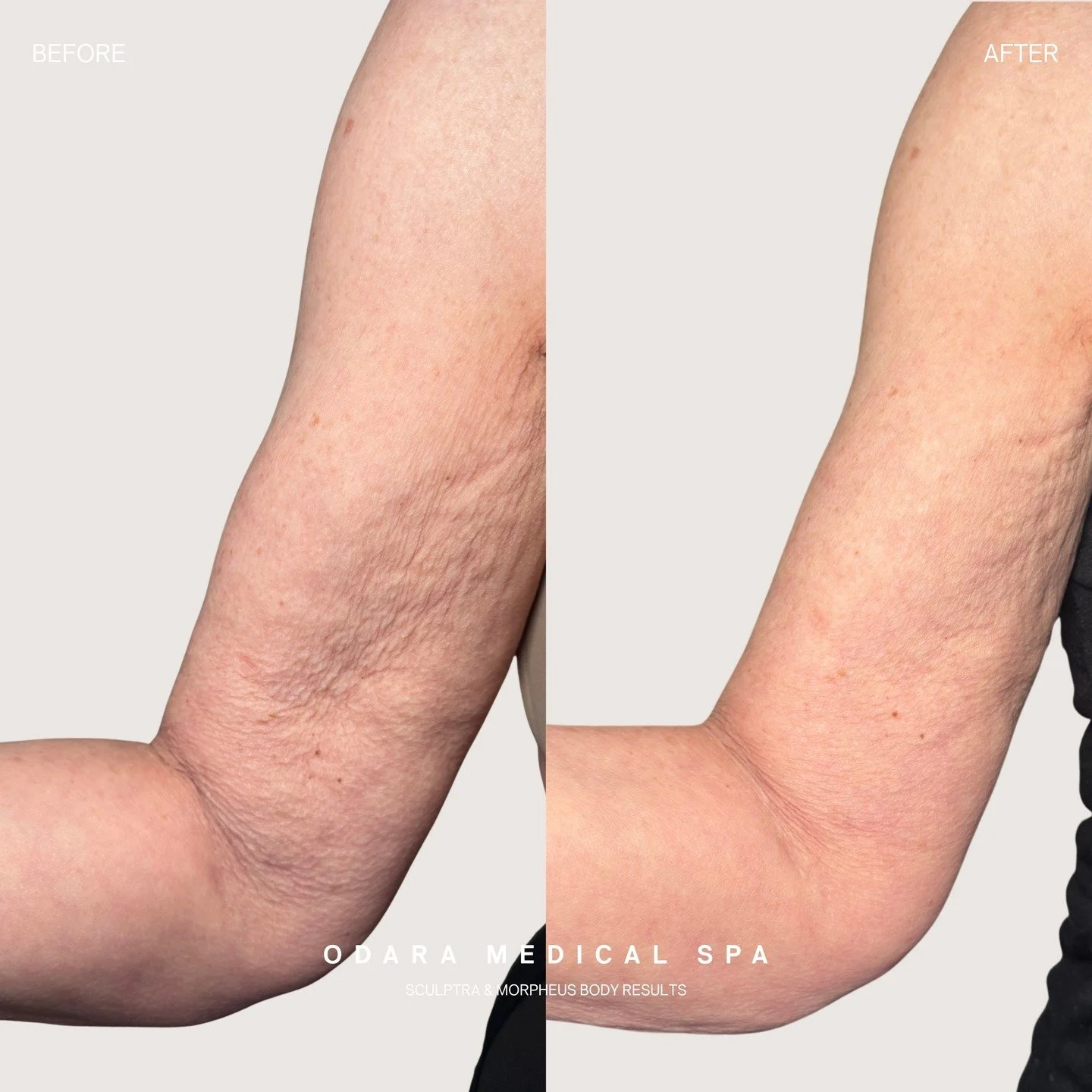 Story time... 

This transformative result is so much more than just an incredible before and after. Why? Because we can ALL relate to this beautiful patient.

Like many of us, she is doing all the right things. She eats healthy, exercises regularly,