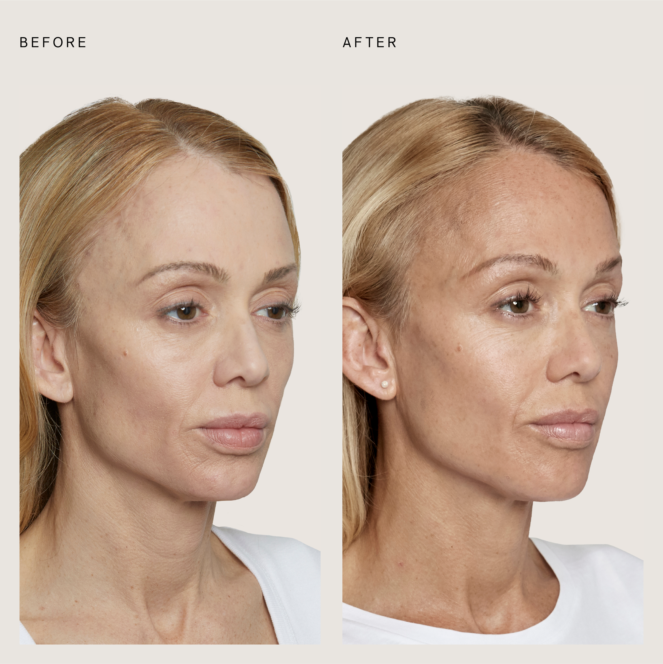 sculptra_01.png
