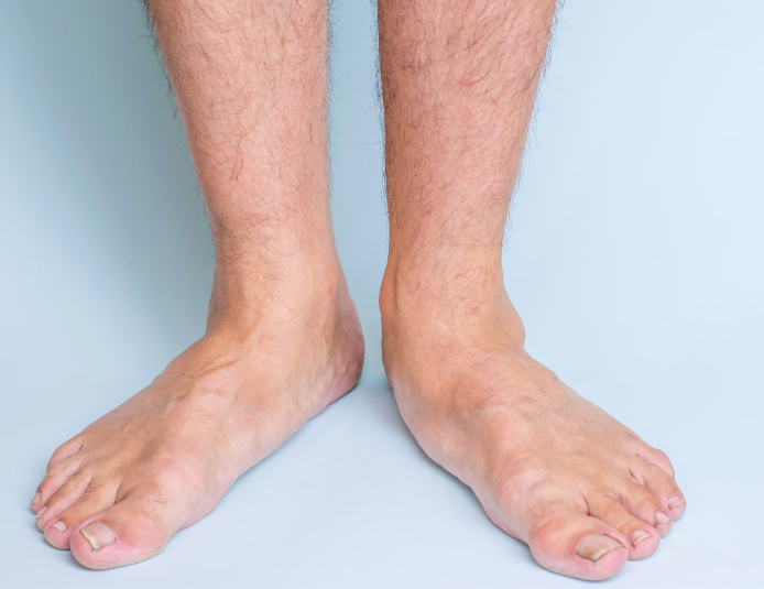 Can You Fix Flat Feet as an Adult? Understanding Arch Implants and Flatfoot Surgery