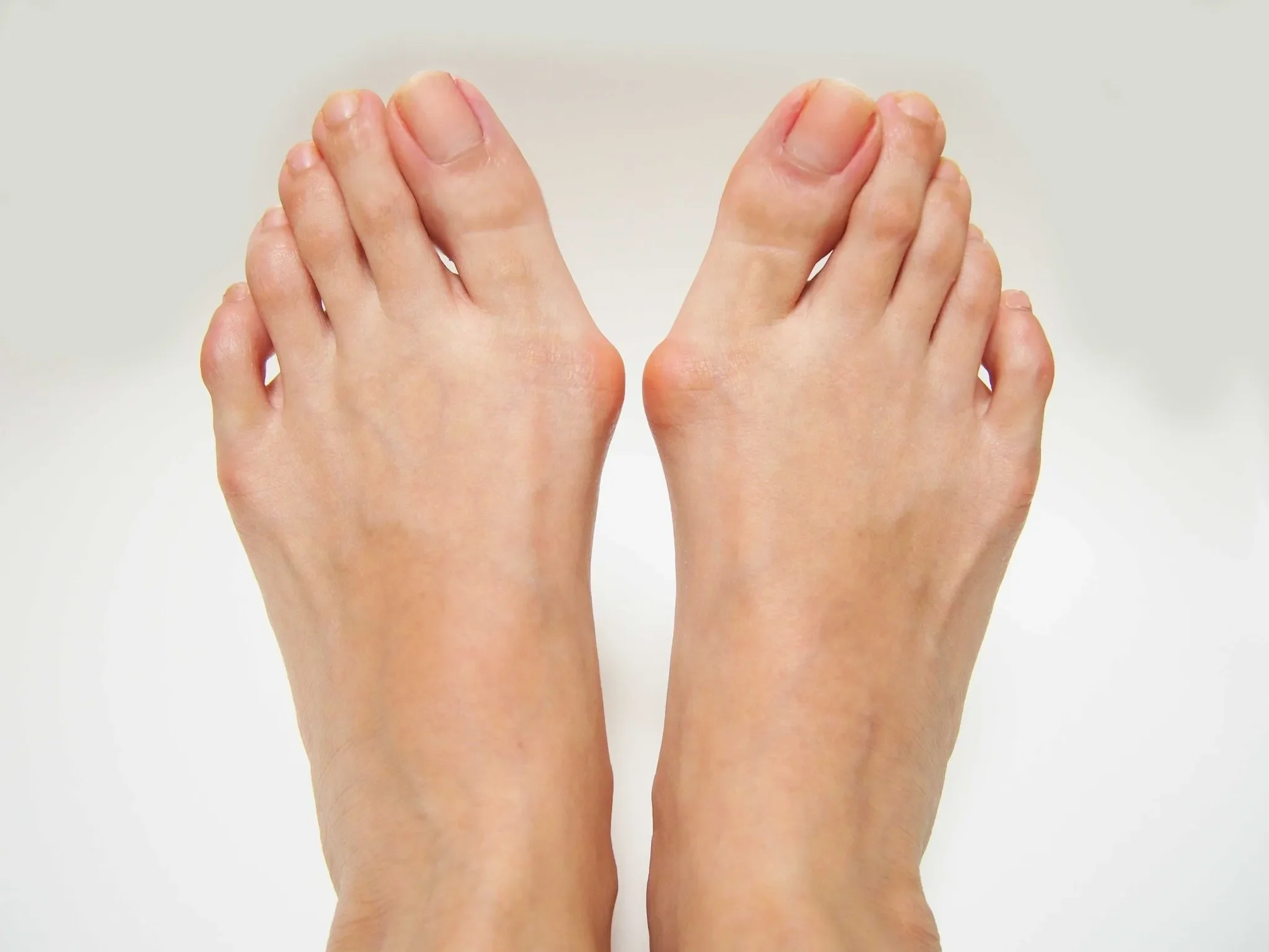 Bunions Explained: What They Are, What Helps, and When Surgery Makes Sense