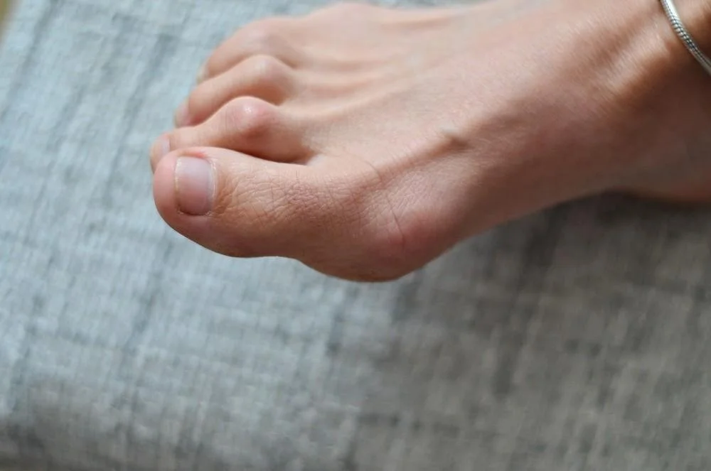 What Causes Hammertoes? The 3 Main Biomechanical Reasons Explained