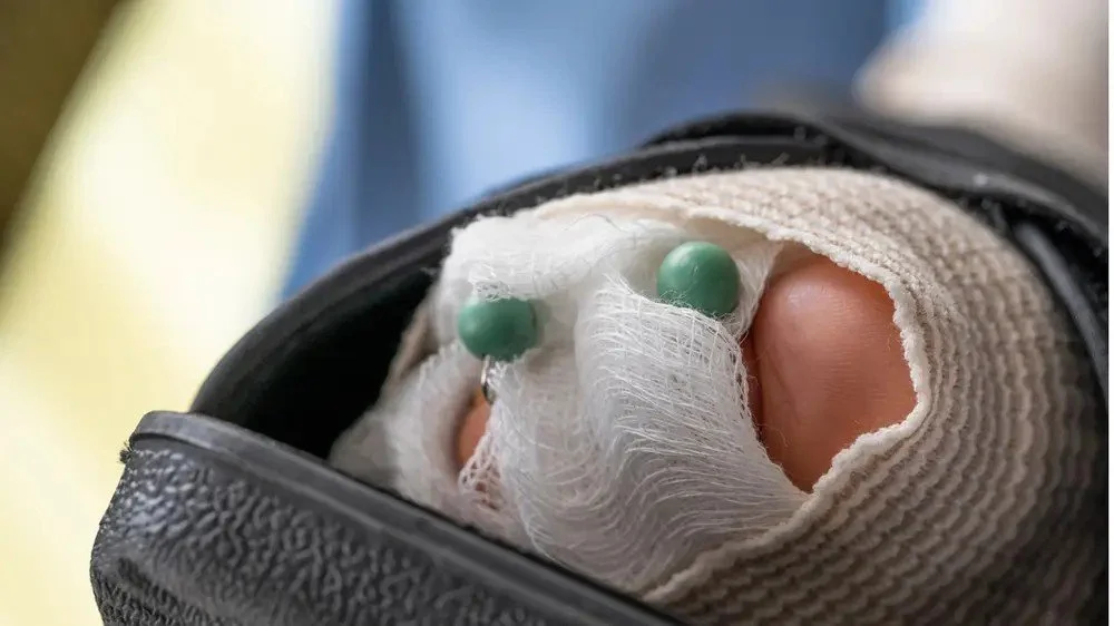 Hammertoe Surgery Explained: Tendon Transfers vs Fusion (What You Need to Know)