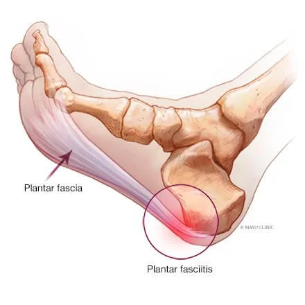 Plantar Fasciitis, Shoes, and Orthotics: What Actually Helps?
