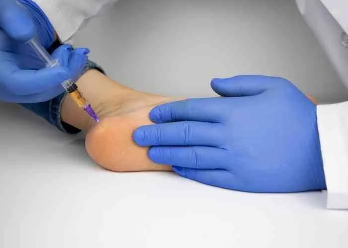 Plantar Fasciitis Myths: Should You Walk Through the Pain? And Are Steroid Injections Safe?