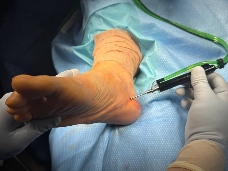 Can Plantar Fasciitis Surgery Really Help? What the Research Actually Says