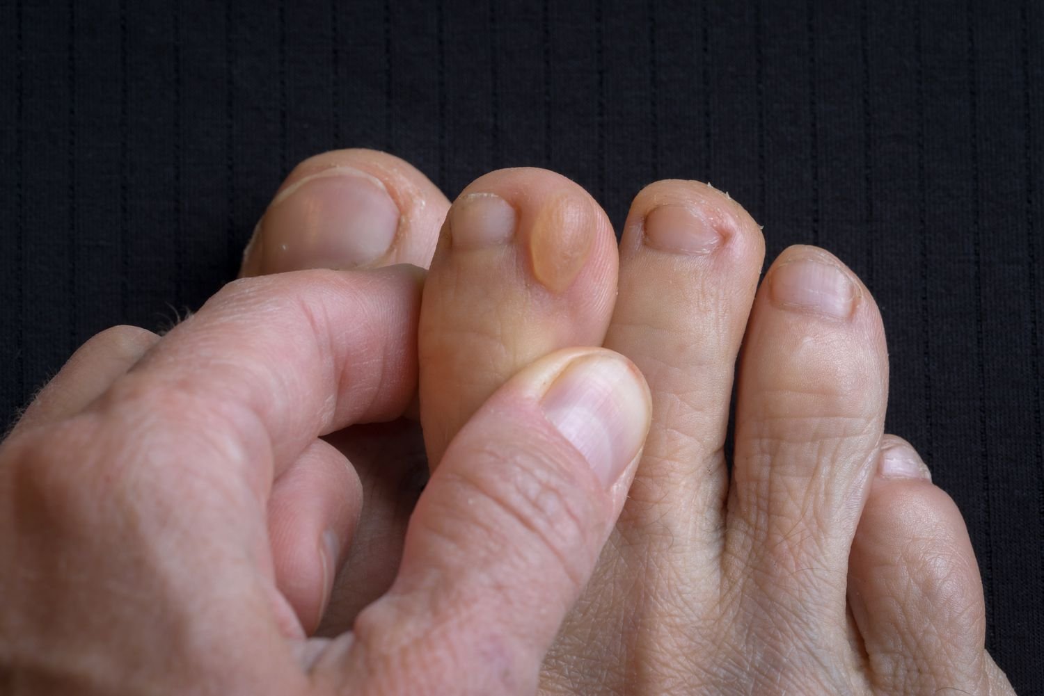 Is It Just a Blister? When a Foot Blister May Need Medical Attention