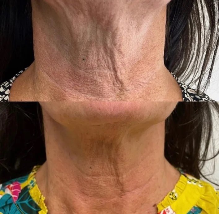 What is PRF? Everything You Need to Know About Platelet-Rich Fibrin ...