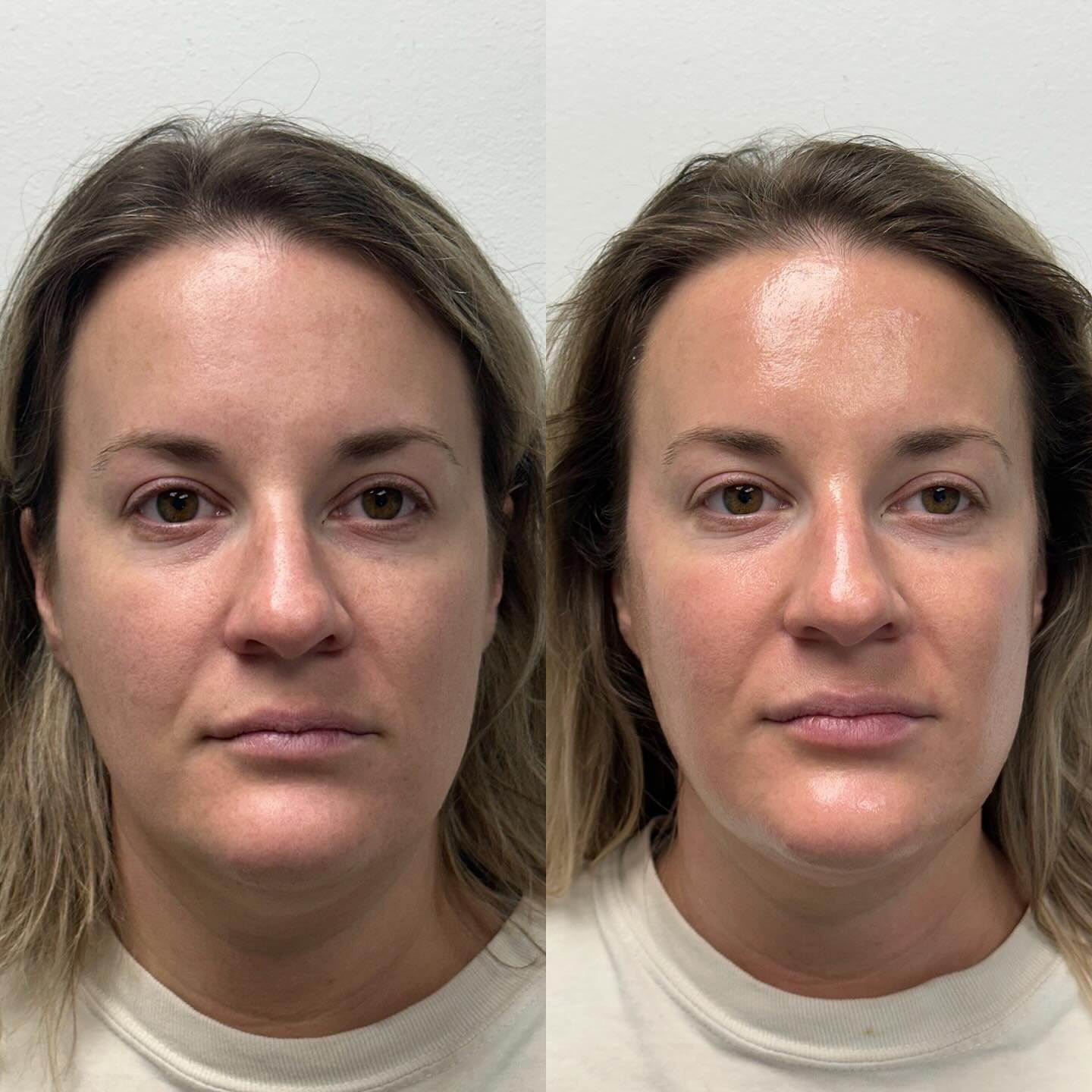 This client came in for a chemical peel + dermaplane combo and the results speak for themselves. 

Brighter, smoother, clearer glowy skin in just one visit. 

Think glazed donut but with medical grade benefits.

Clears active breakouts. 
Fades stubbo
