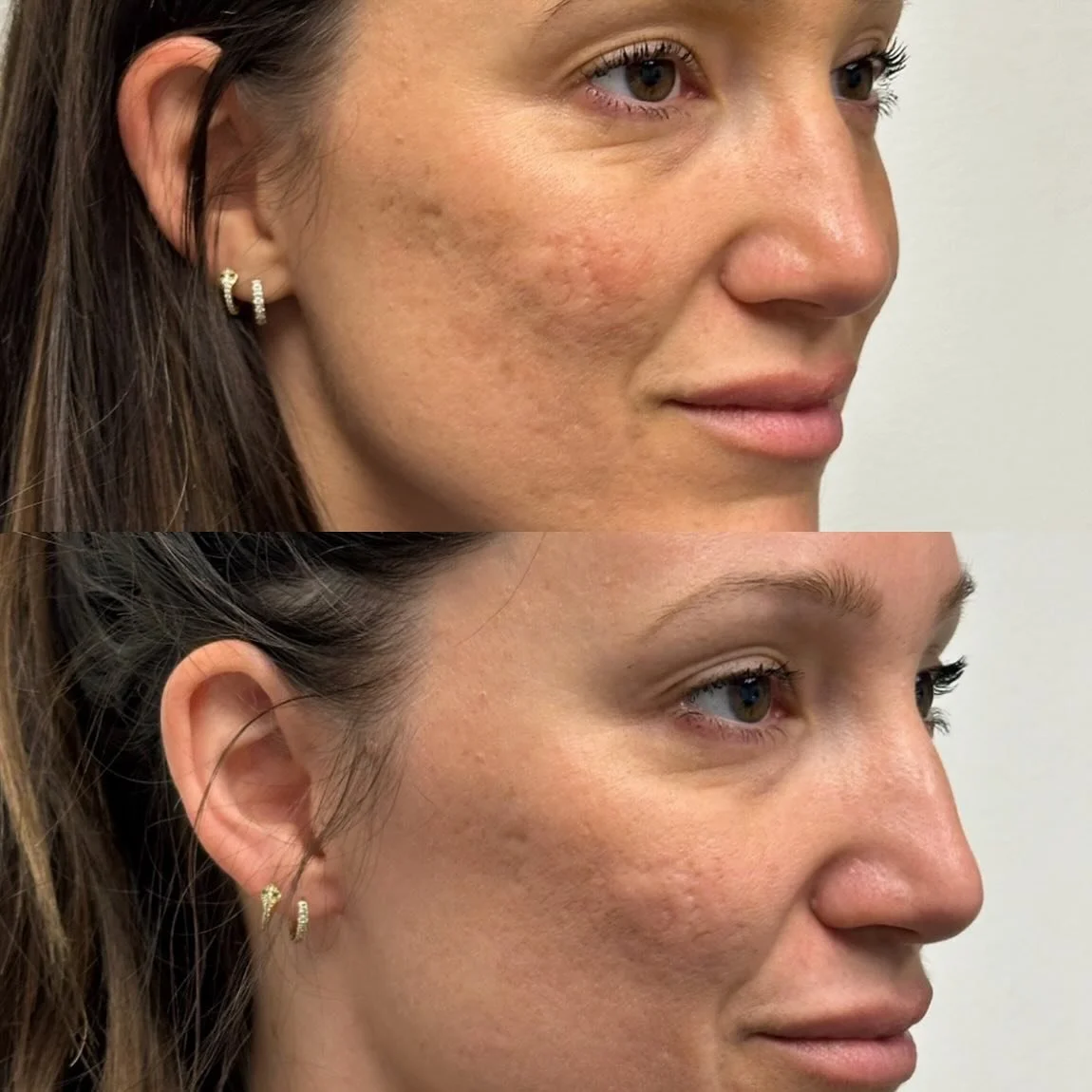 Consistency = Results. 

This patient just finished her 4th TCA Cross peel and the glow speaks for itself. 

Notice how her texture looks smoother, pigment is more even and her overall skin is radiating? 

TCA peels work beneath the surface to resurf