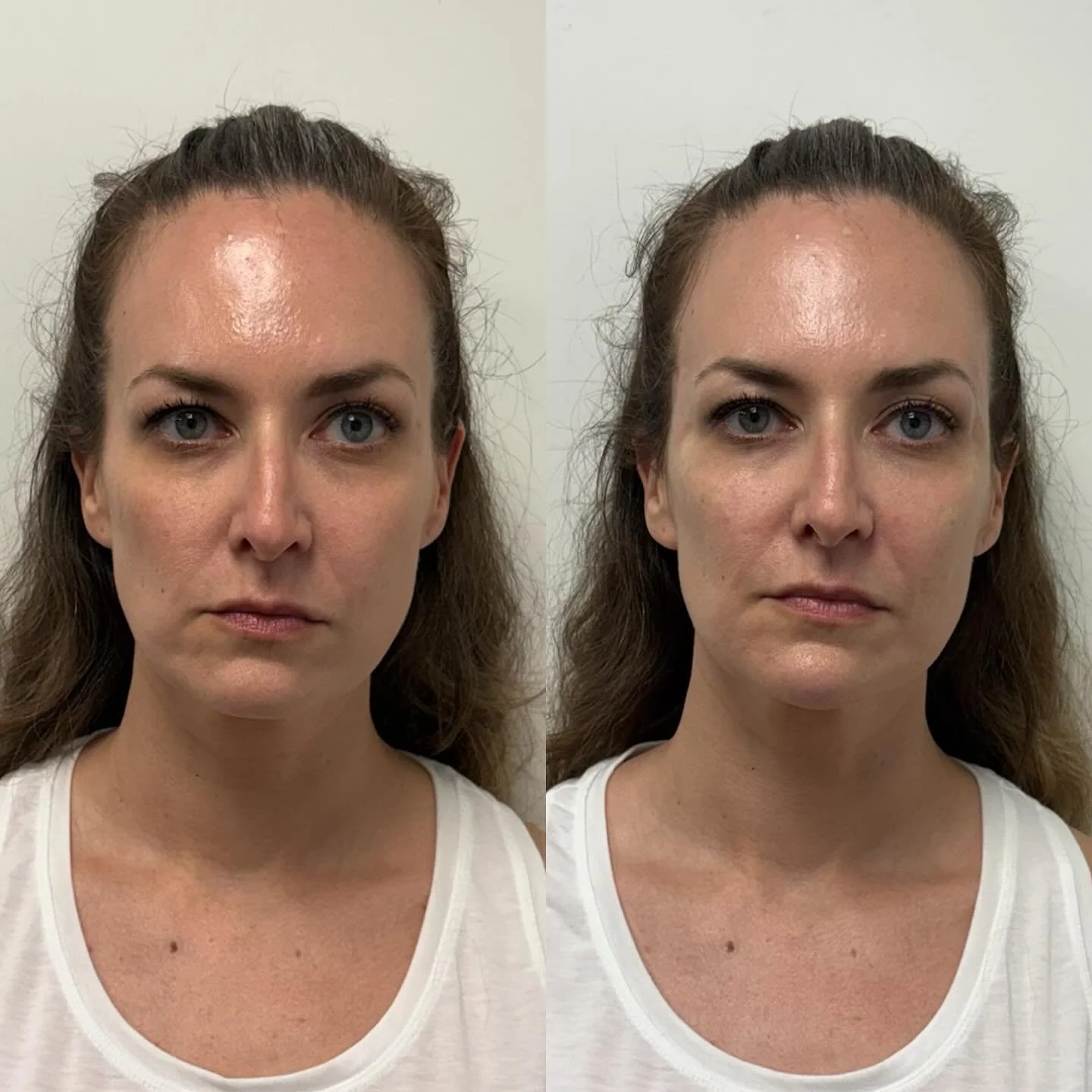 With this patients facial balancing appointment it&rsquo;s hard to tell where she even had filler placed.

She looks more refreshed overall and wanted to stay looking herself just a few years younger.

That&rsquo;s exactly what she got 😏

With a ful