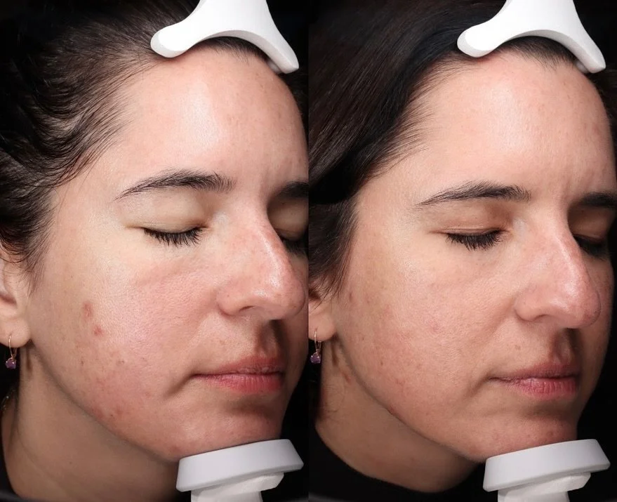 This client came in with acne concerns. 

After discussing her goals &amp; budget, we came up with a custom treatment plan of 6 SkinBetter Peels &amp; medical-grade skincare at home 🧪

Remember, results come from 80% home care and 20% treatments!