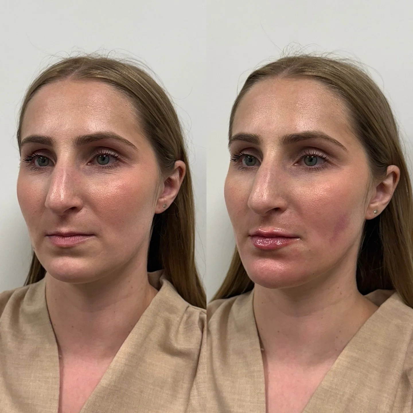 Clearly she was already flawless, but wanted her lips to be more voluminous. 

I explained that just doing her lips would cause them to have unnatural projection. She could still do lip filler, but also doing a little filler in her chin and chin shad