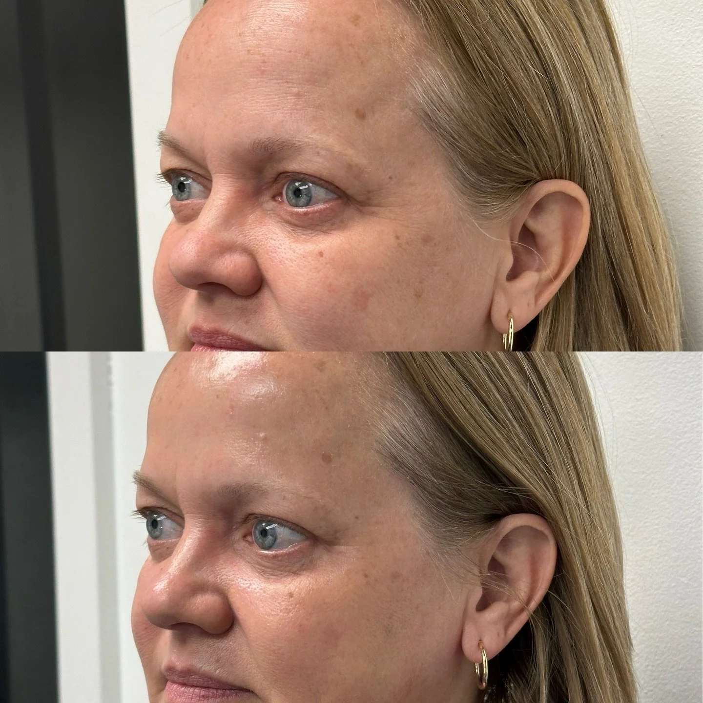 Two SkinBetter peel + dermaplane sessions in, and her skin keeps improving✨ 

Brighter, smoother, and sun spots fading fast.

We offer peel packages of 3 or 6 because real change comes with consistency🤌🏽