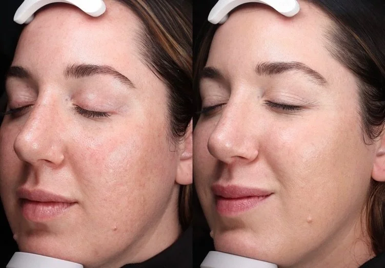 Botox without skincare? Not enough🙅🏽&zwj;♀️

Laser treatments, peels, injectables, and medical-grade skincare at-home  work together to give real, lasting results. When you combine them, your skin truly thrives!