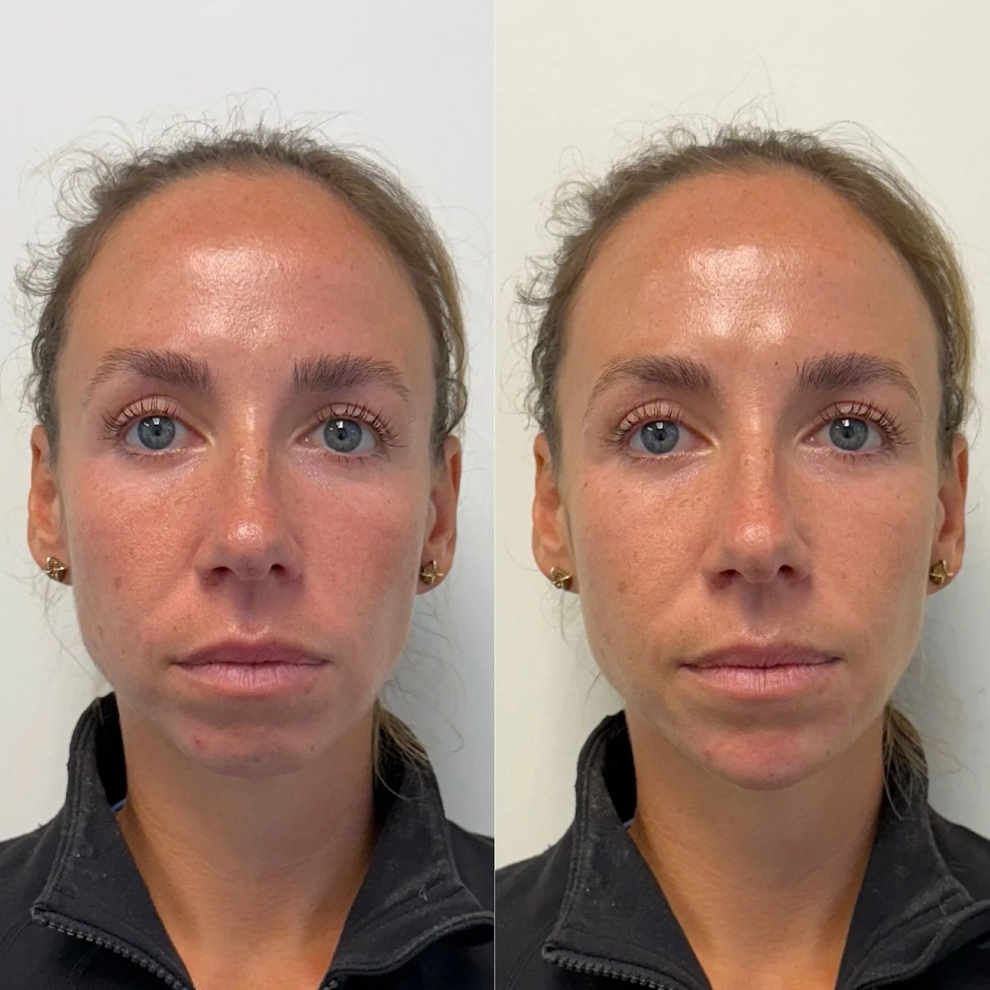 Chin and shadow filler are the most common fillers we do at TAM and for good reason: 

1️⃣ Over time, your chin bone shortens and widens, creating a more masculine shape. Filler here restores feminization.

2️⃣ Treating the chin muscle with Botox can