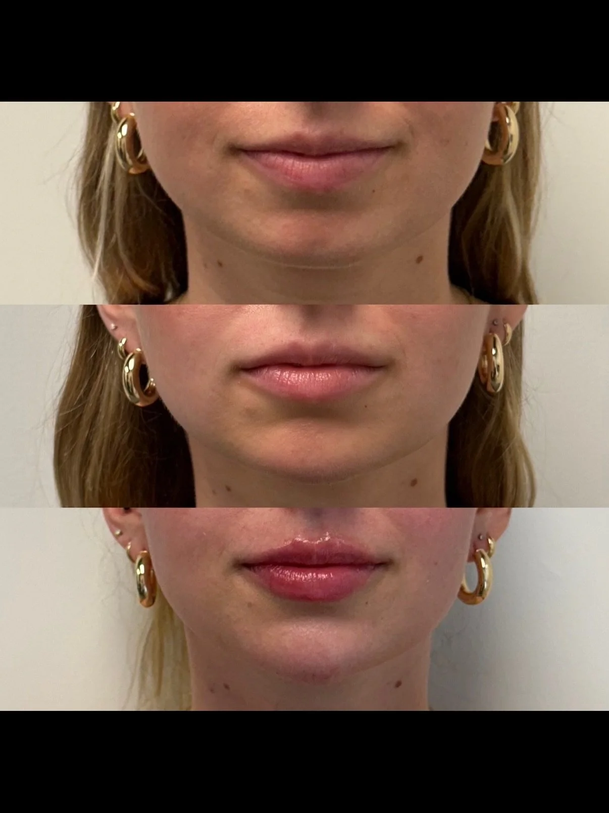 She came in one year ago wanting lip filler, but instead we suggested chin filler.

The next appointment we saw her for botox and she told us it was the best thing she&rsquo;s ever done.

One year later we did a lip-chin combo with filler. We love wh