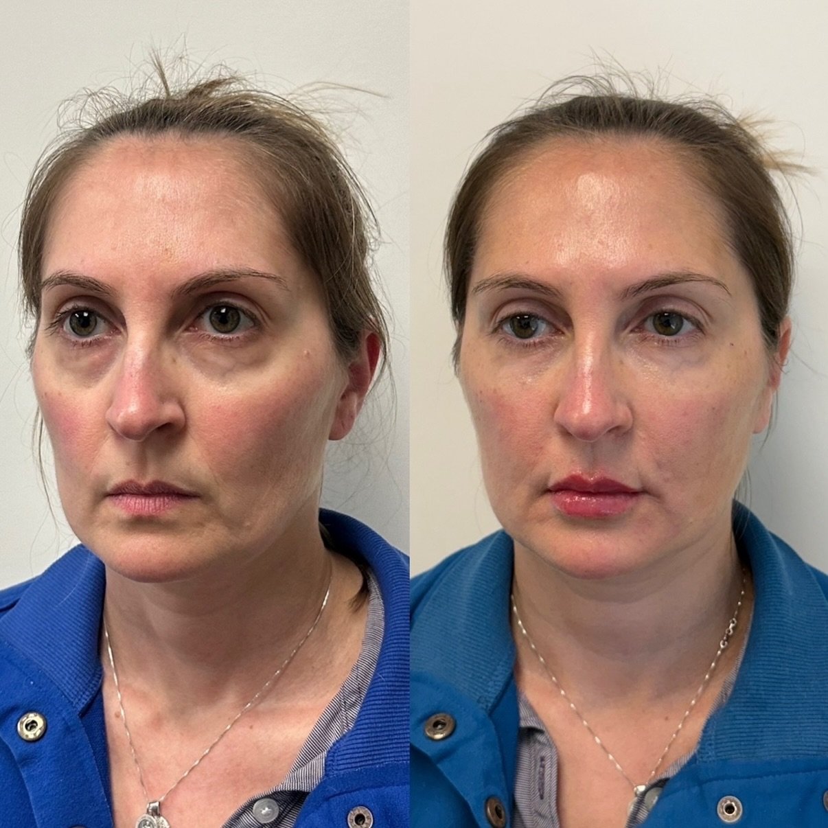 Before any filler ➜ Immediately after her annual refresh. 

Two syringes used across the midface, undereyes, lips, chin, and small lines for a balanced, lifted result.

Haven&rsquo;t had a Full Face Assessment yet? Ask for one at your next appointmen