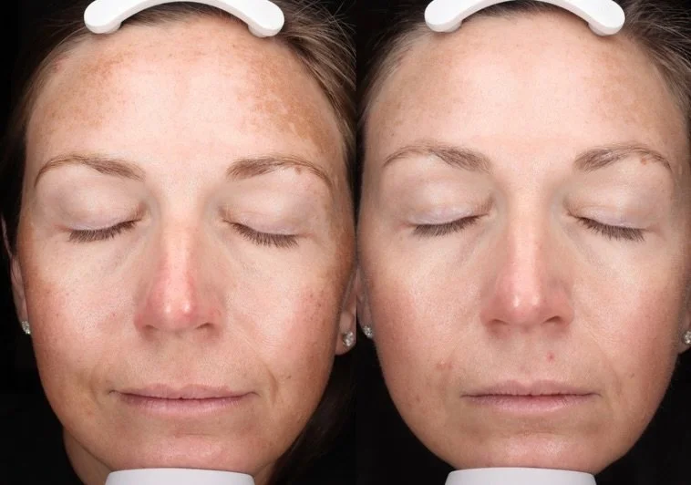 This patient has one of the most stubborn cases of melasma I&rsquo;ve treated and after 3 VI Peels, we&rsquo;ve finally seen progress!

Skincare and treatments take time, but consistency + the right treatment plan makes a difference.